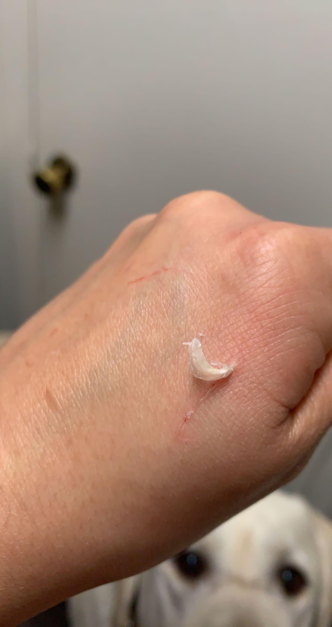 My cat scratched me and her nail shed got stuck in my skin r