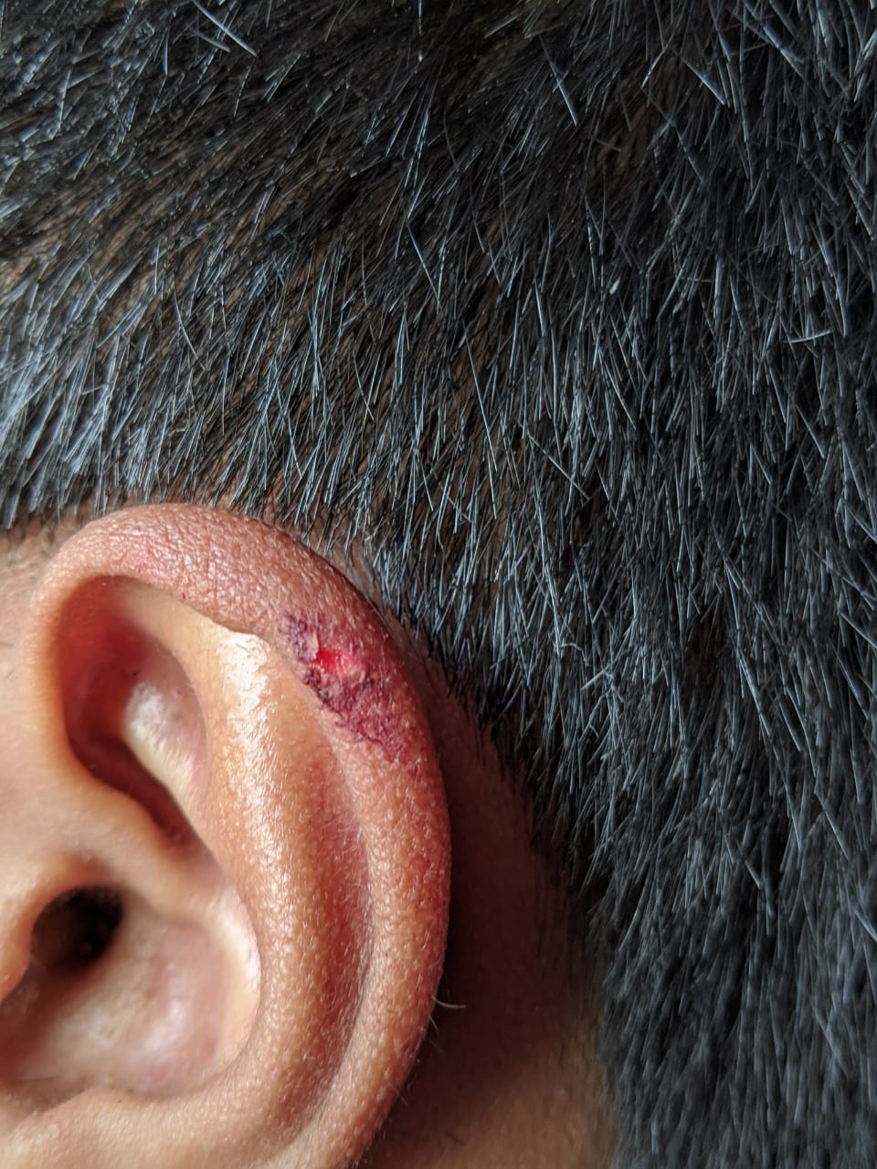 Went for a hair cut, got my ear cut instead. r/Wellthatsucks