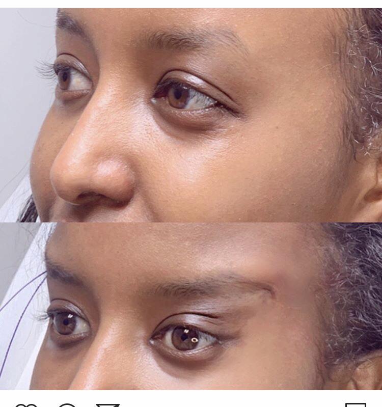 cat eye thread lift cost uk Johnson Grossman