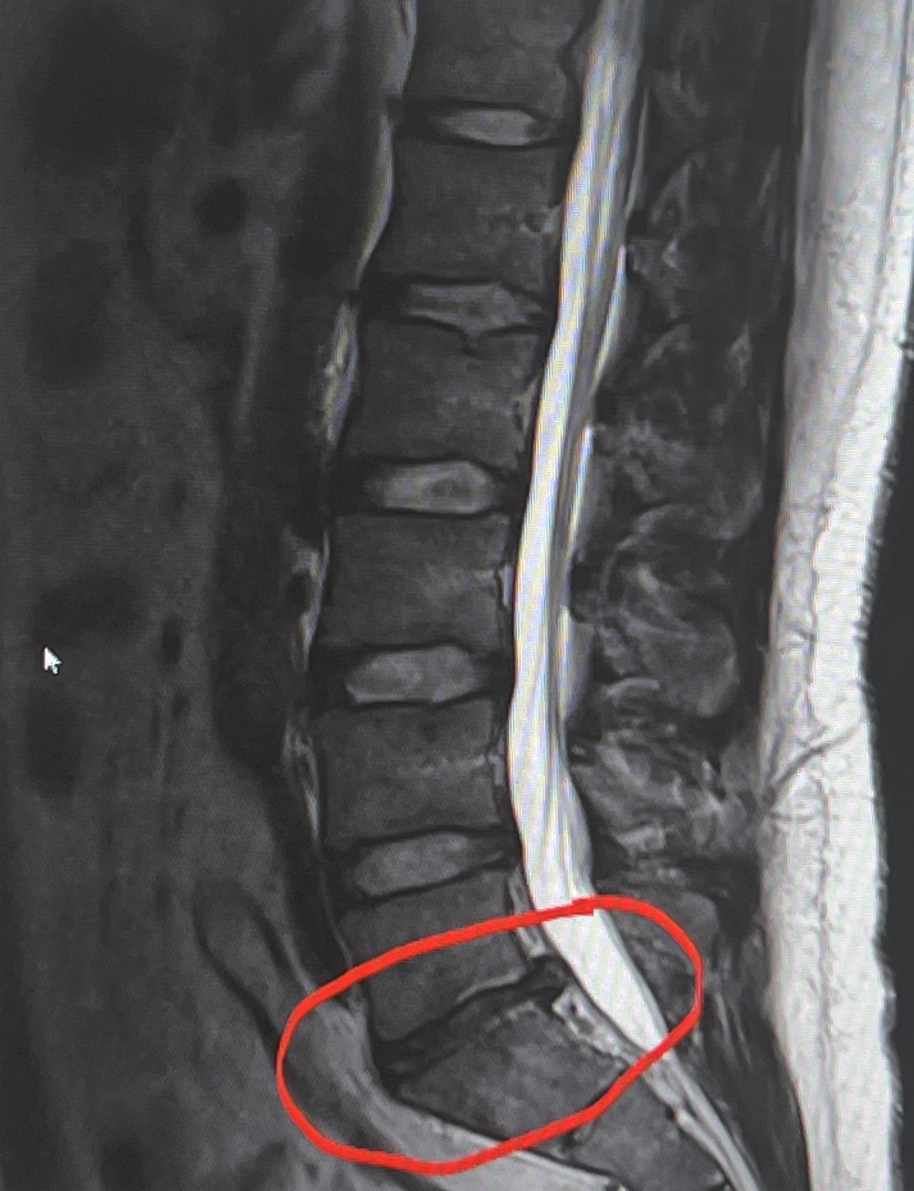 L5S1 Disc herniation. NEED SURGERY ADVICE! (Story in comments) r