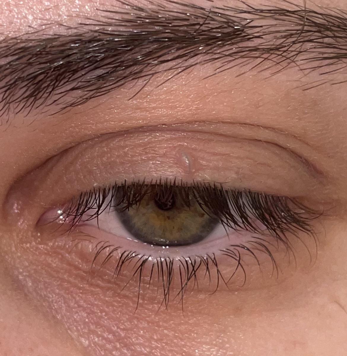 Ingrown eyelash trapped under skin, not sure how to get it out. It’s