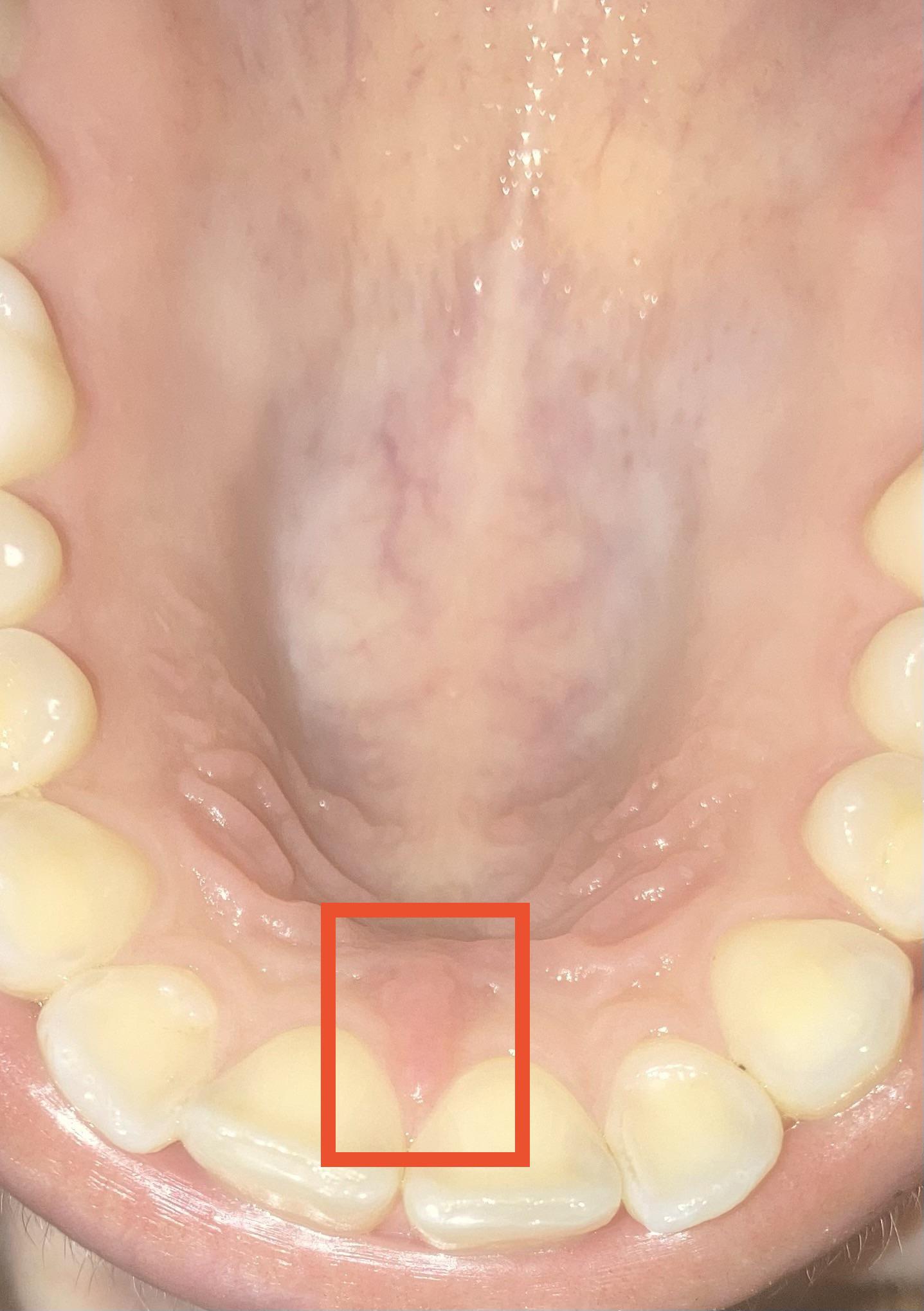 My incisive papilla (?) feels swollen and sore but I haven’t burned it