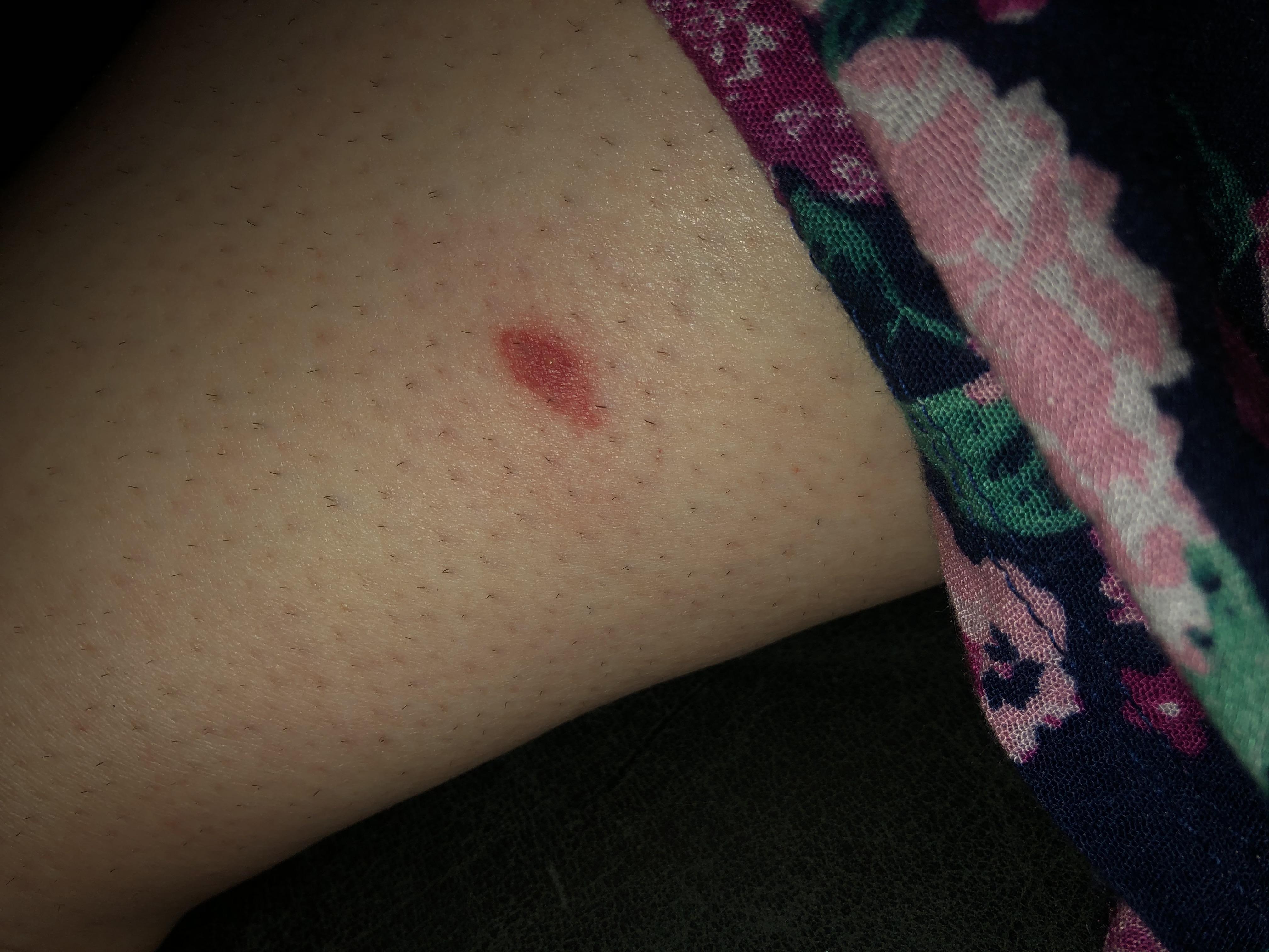 Can anyone help me identify what this bug bite could be? r/camping