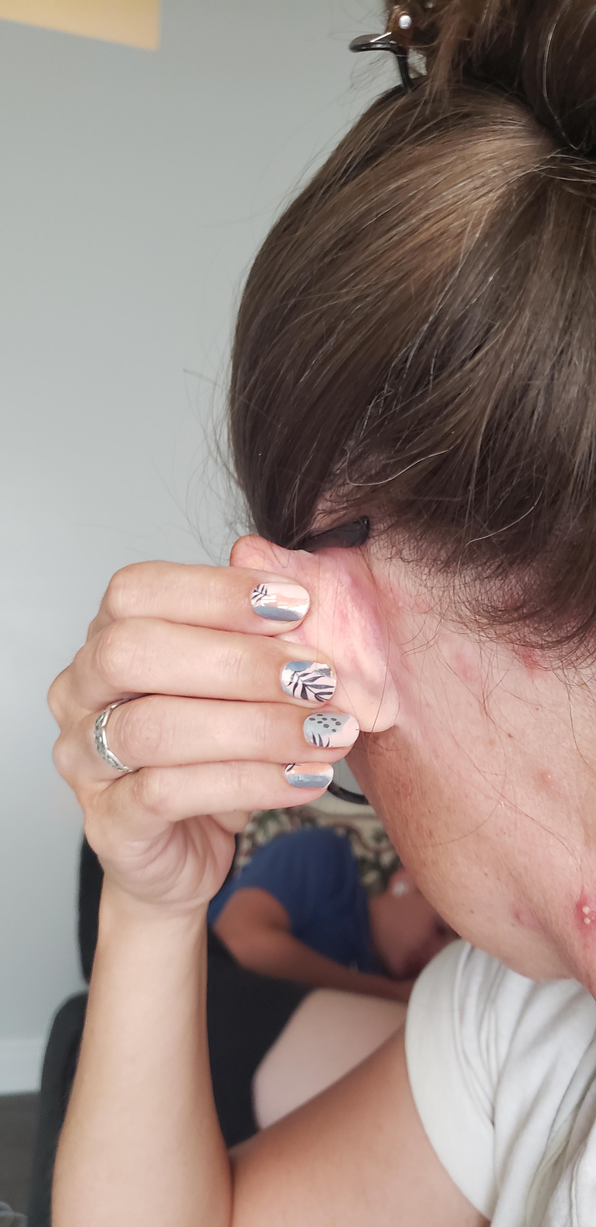 Should I be concerned about shingles on my ear? r/shingles