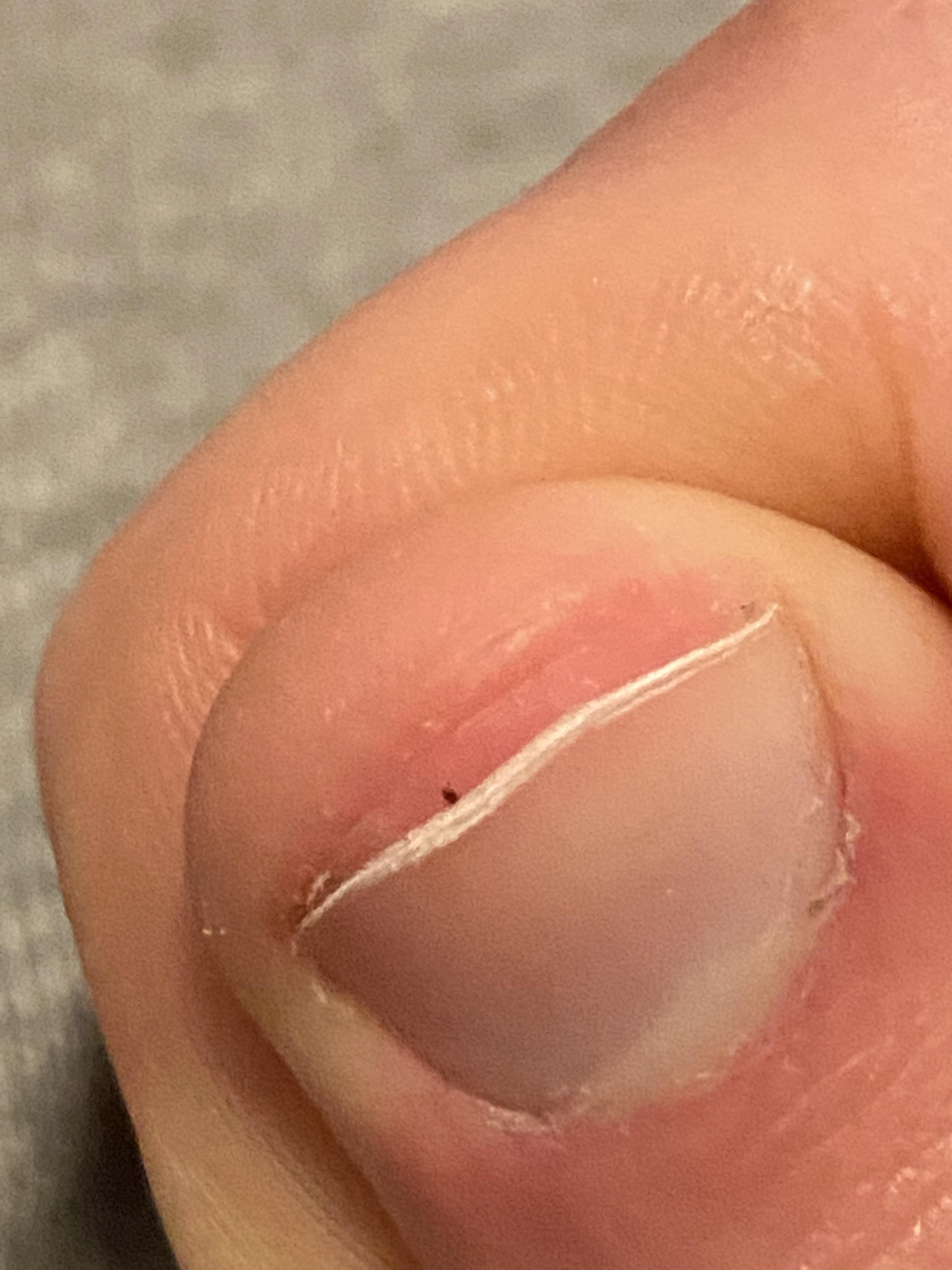 Black spot under nail, any idea what it could be r/DermatologyQuestions