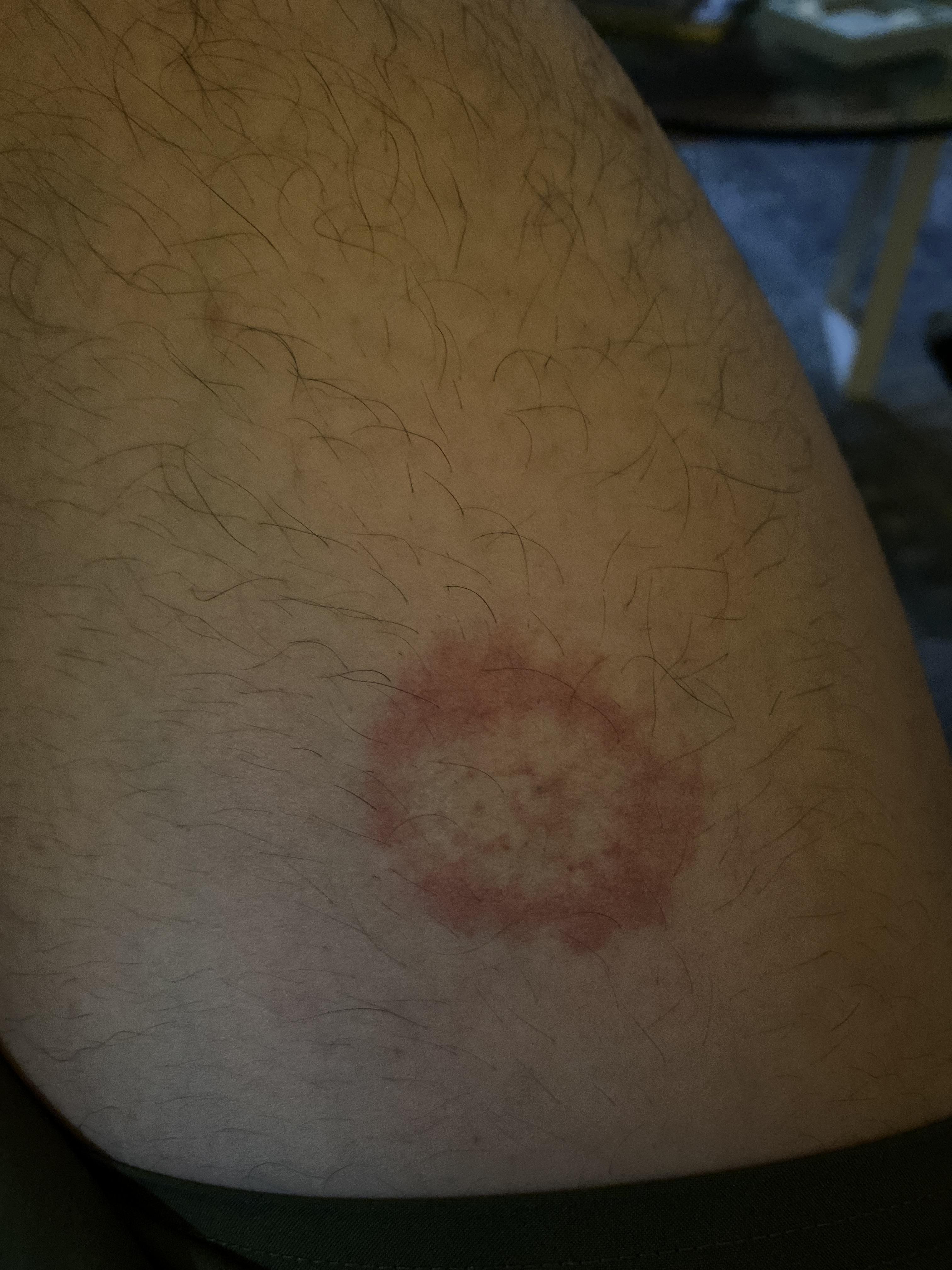 Ring worm, Lyme disease or just a circular rash. Don’t know how it