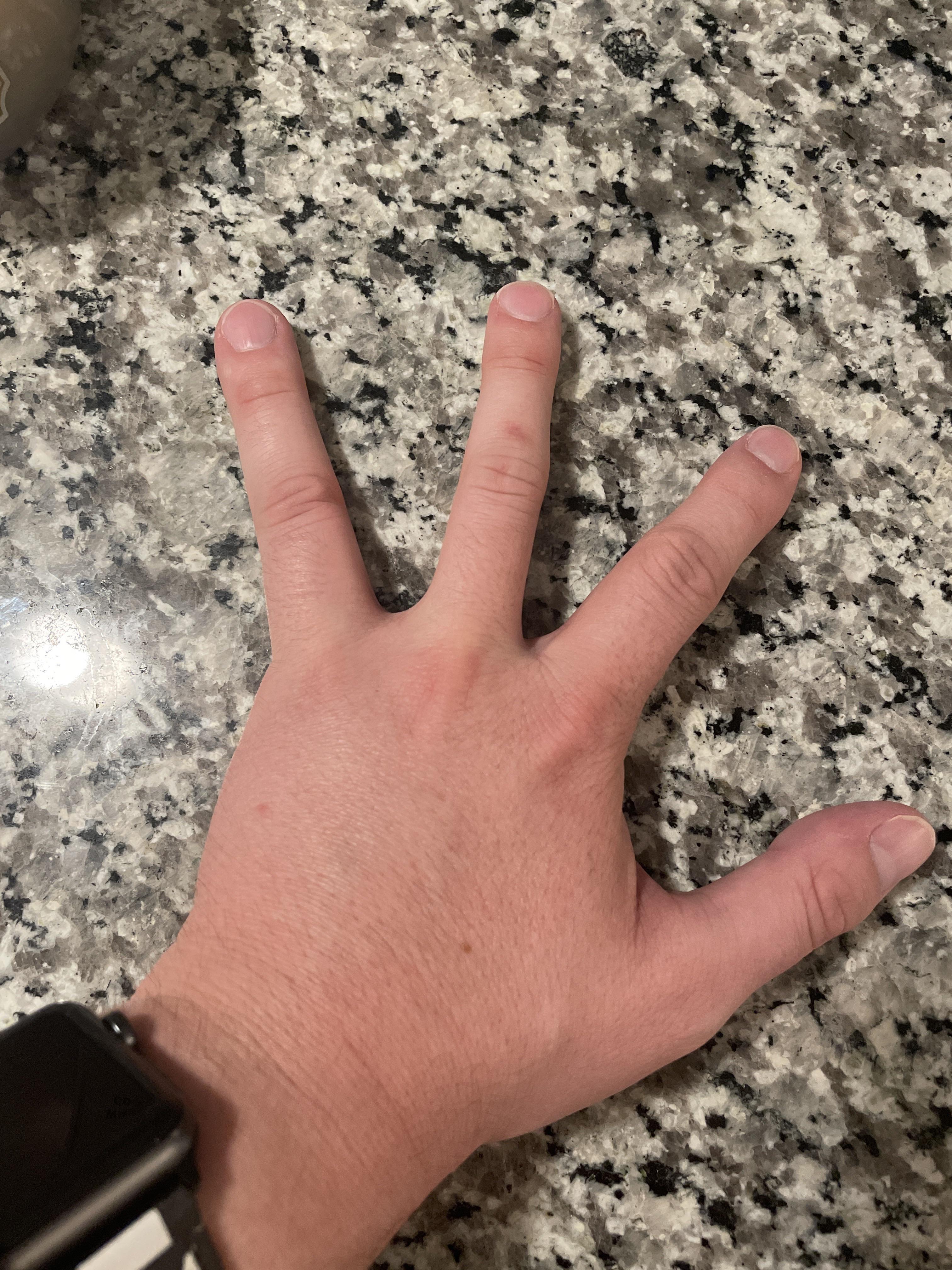 I was born with only four fingers on my left hand r/mildlyinteresting