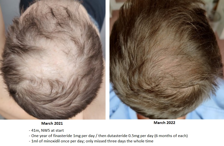 One year of hair loss recovery progress r/malehairadvice