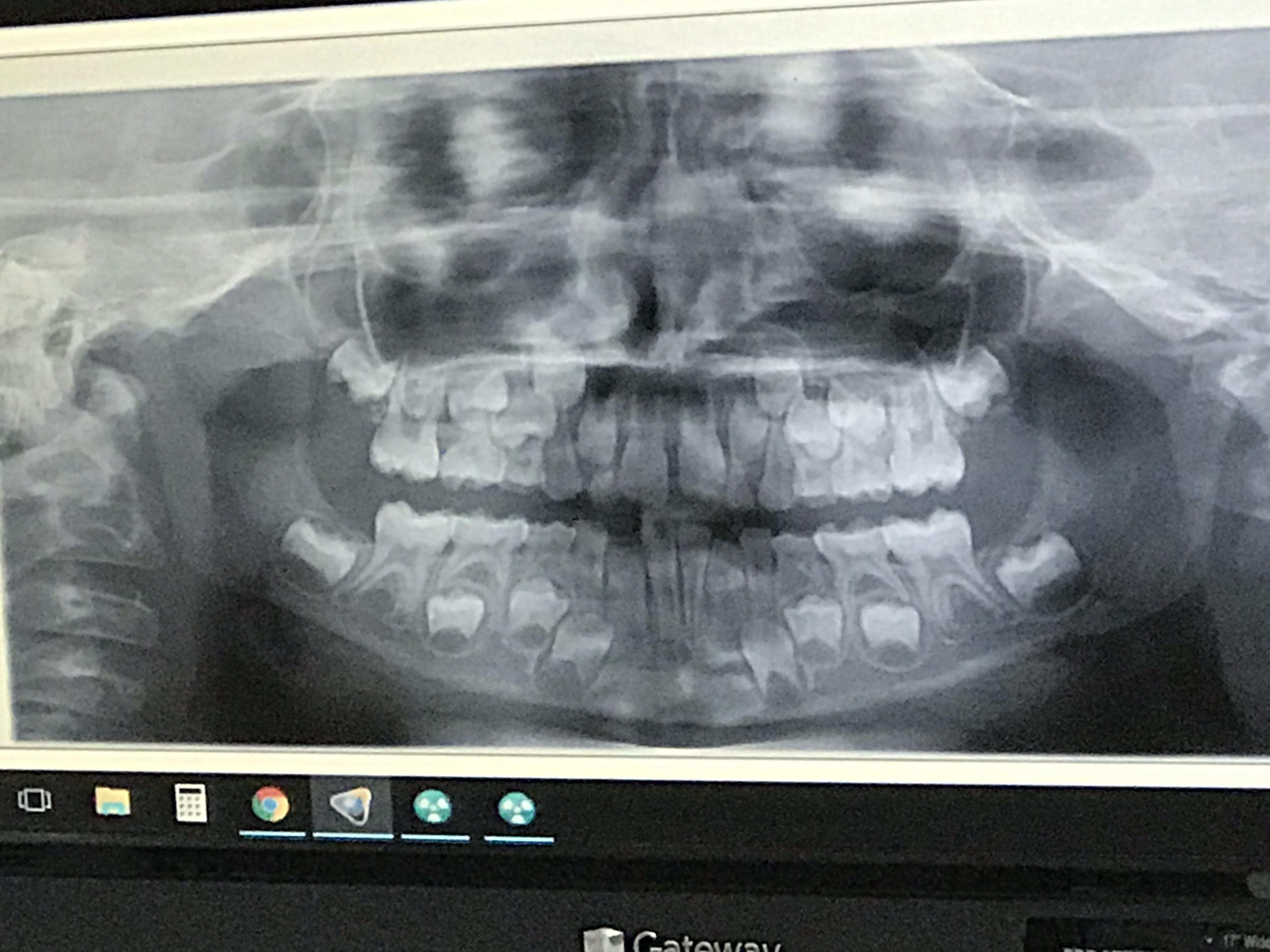 My son got his first dental xray today and you can see all his adult teeth preparing to emerge