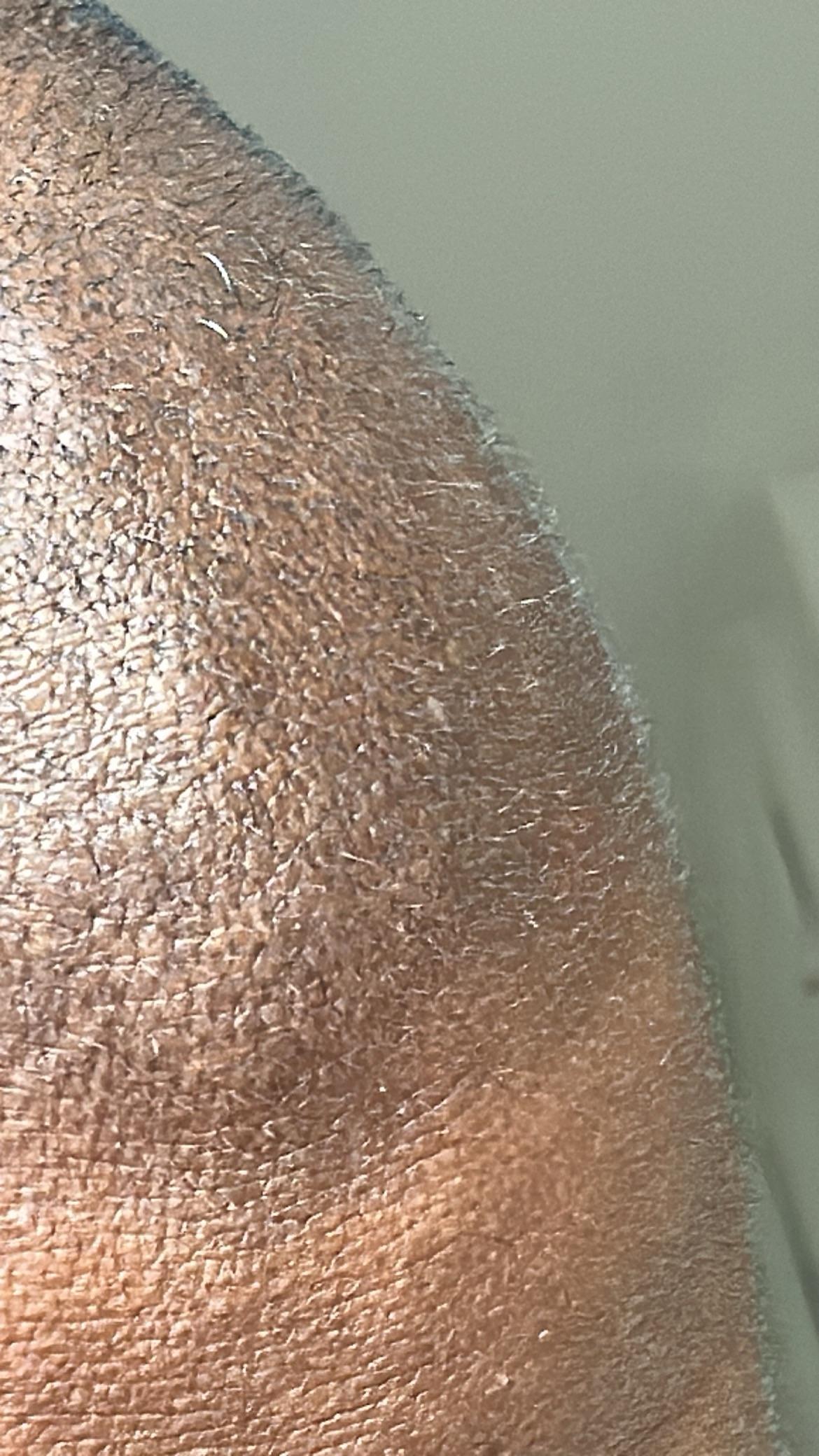 Closeup of Vellus Hairs on the bald spot in my hairline…am I on the