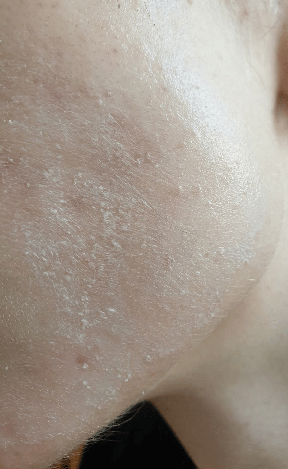 Need help, 2 weeks ago I started using Duac Gel (BenzyolPeroxide