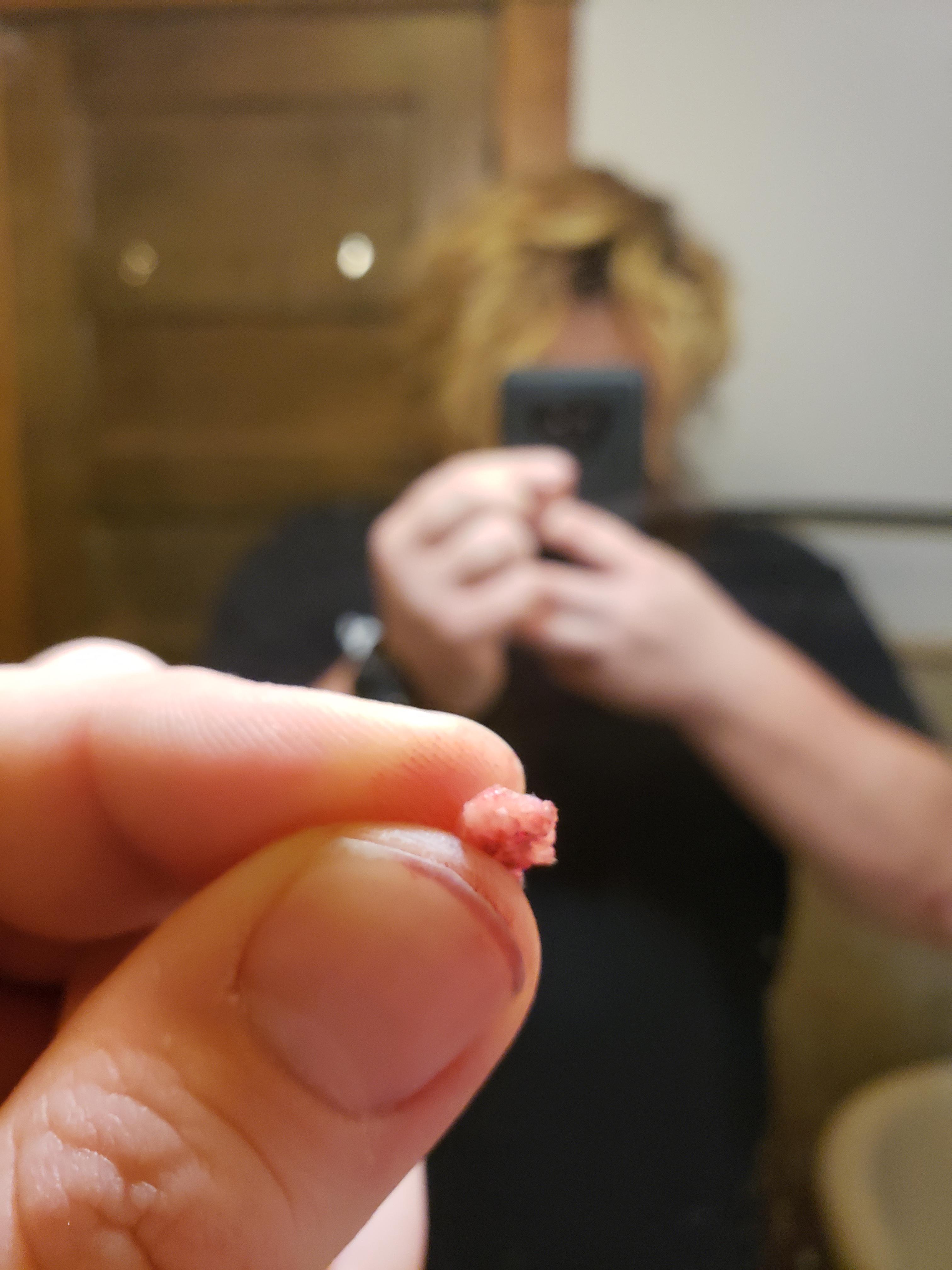 Decided to pull this dude off my arm last night... Warts