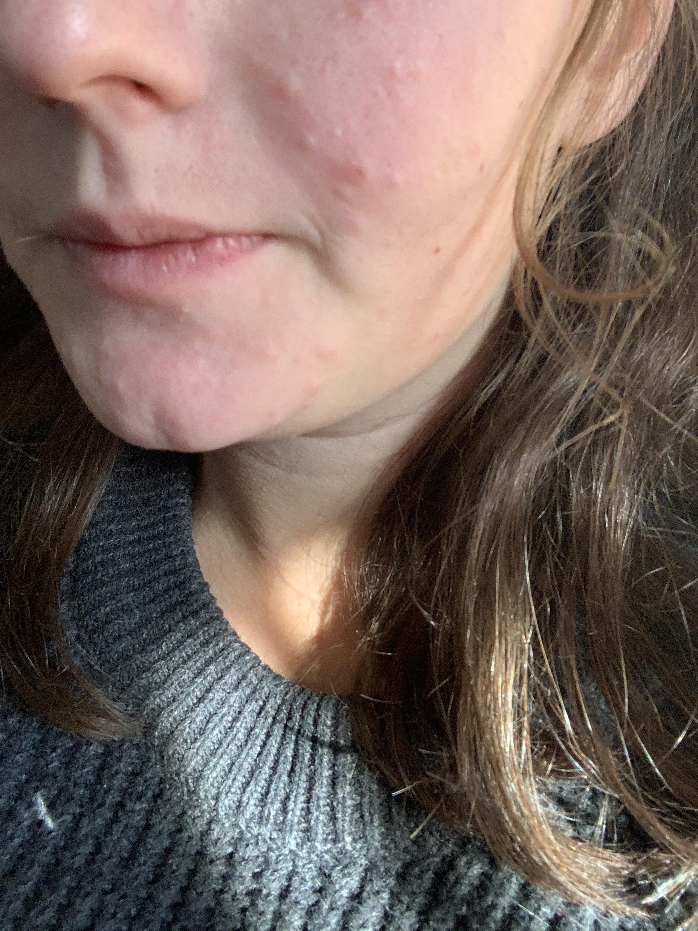 This rash on my face started about 15 months ago when I got pregnant