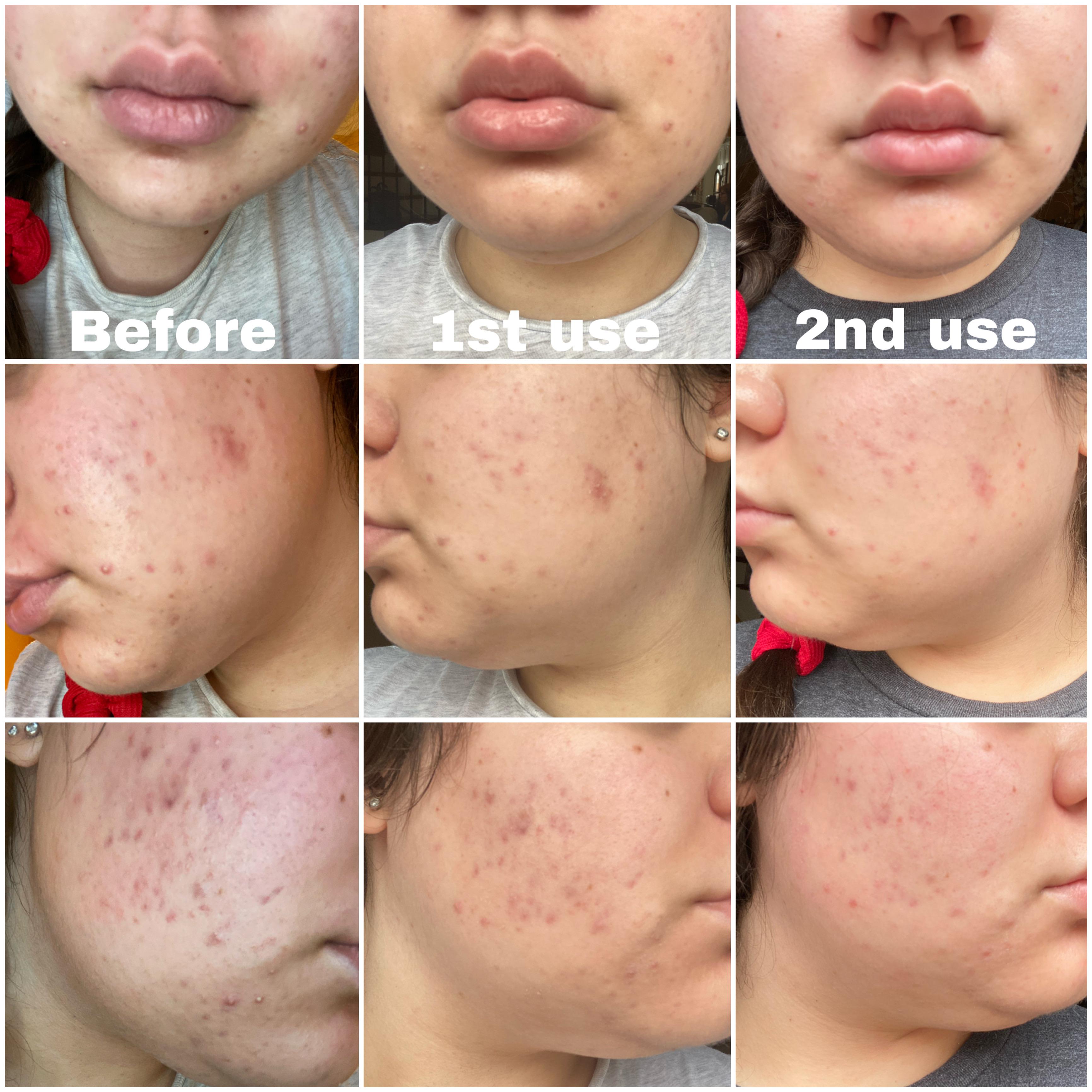 How To Clean A HighFrequency Wand Cleanestor