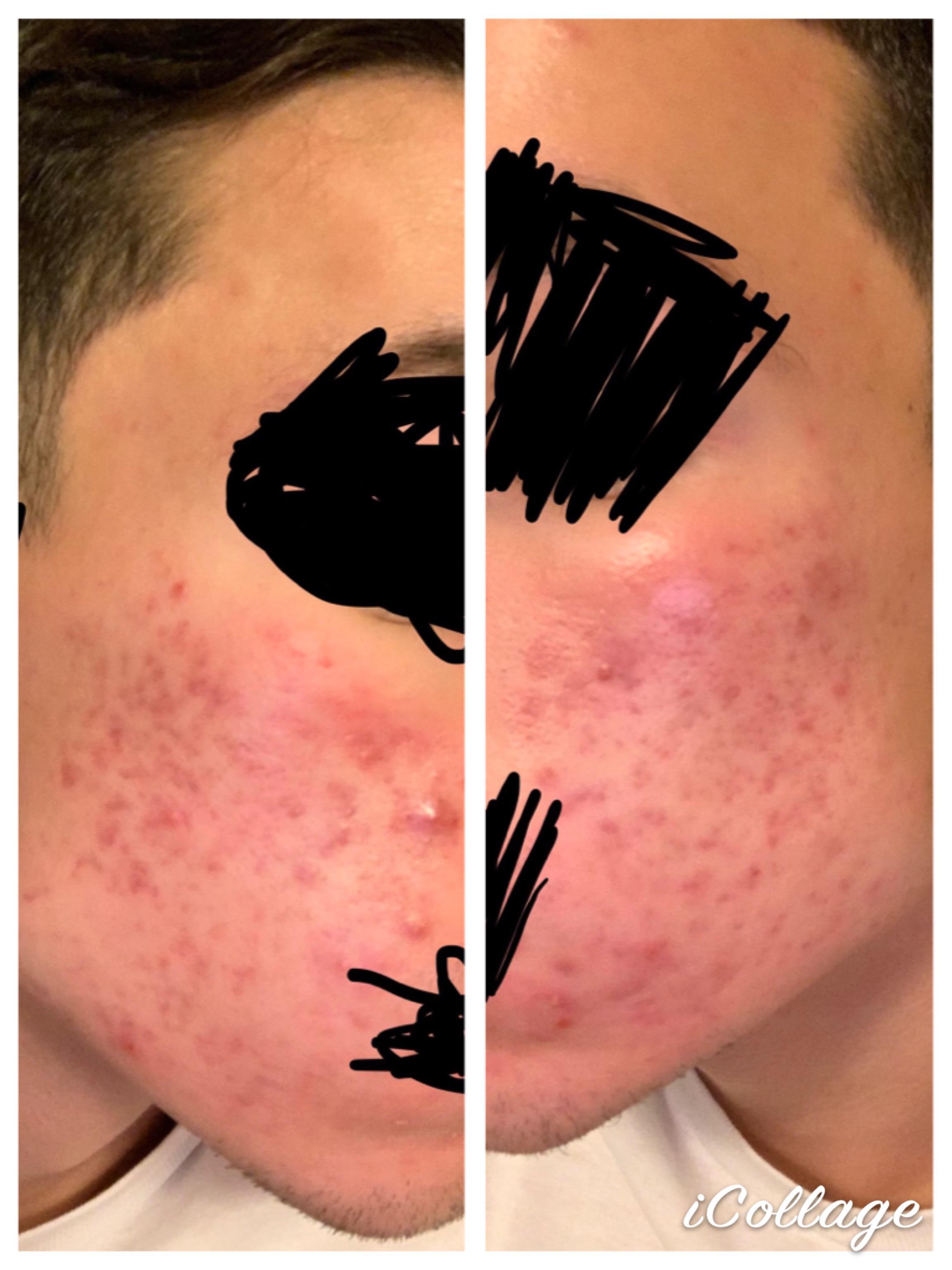 Is this active acne or PIE? It seems that my face stayed the same from