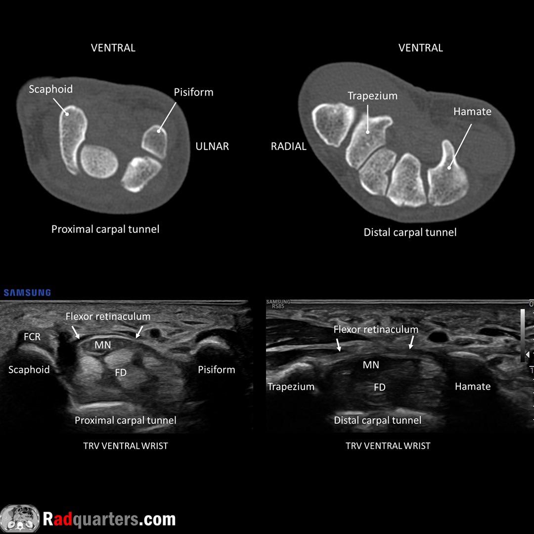 CT & ultrasound anatomy of the carpal tunnel r/Radiology