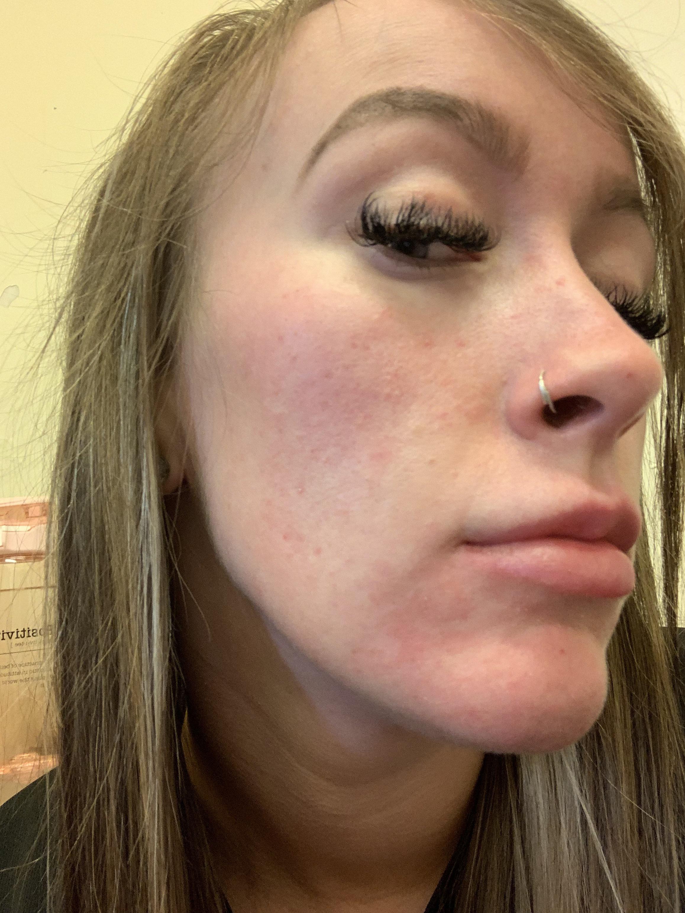 just had a reaction after eating a fruit salad with red itchy rash all