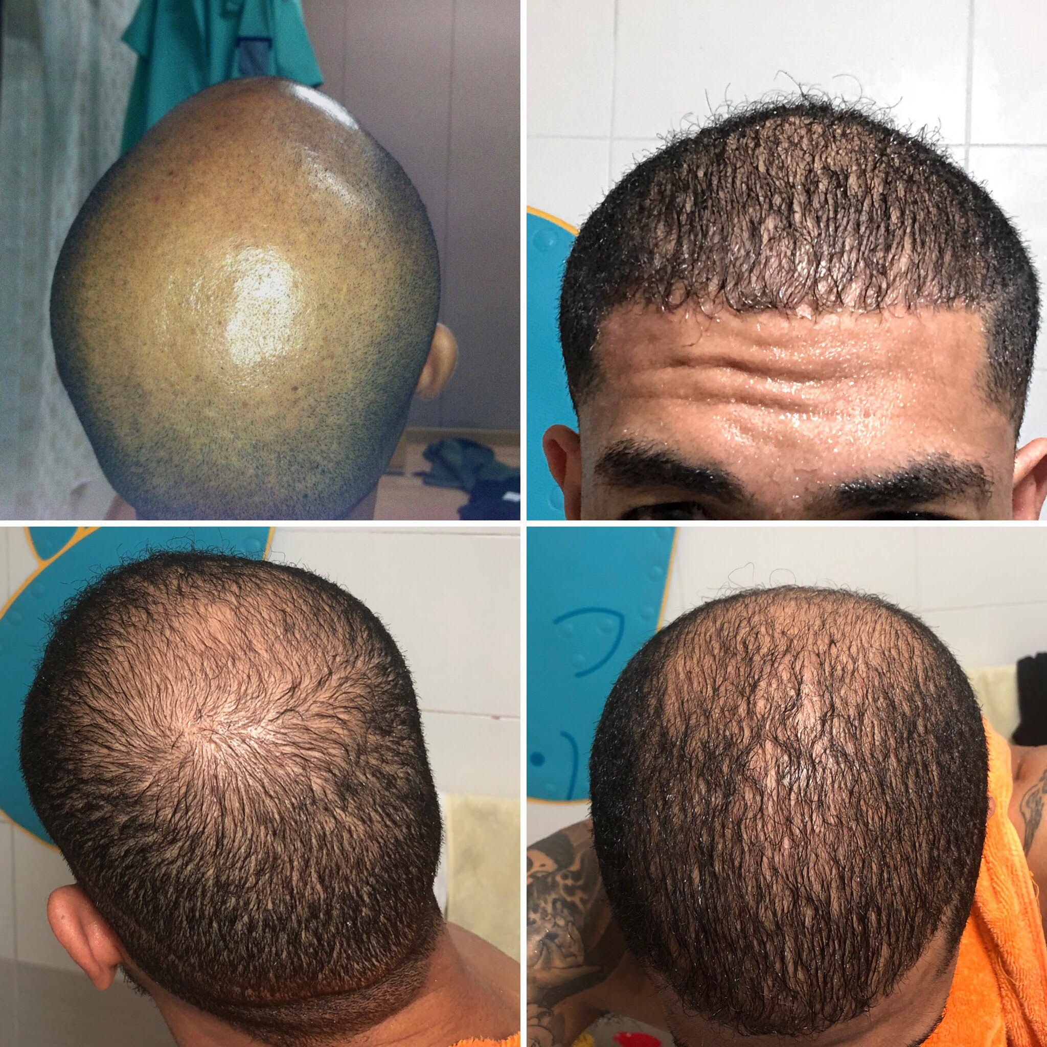 19+ Hair Transplant Korea MagnusKeyanna