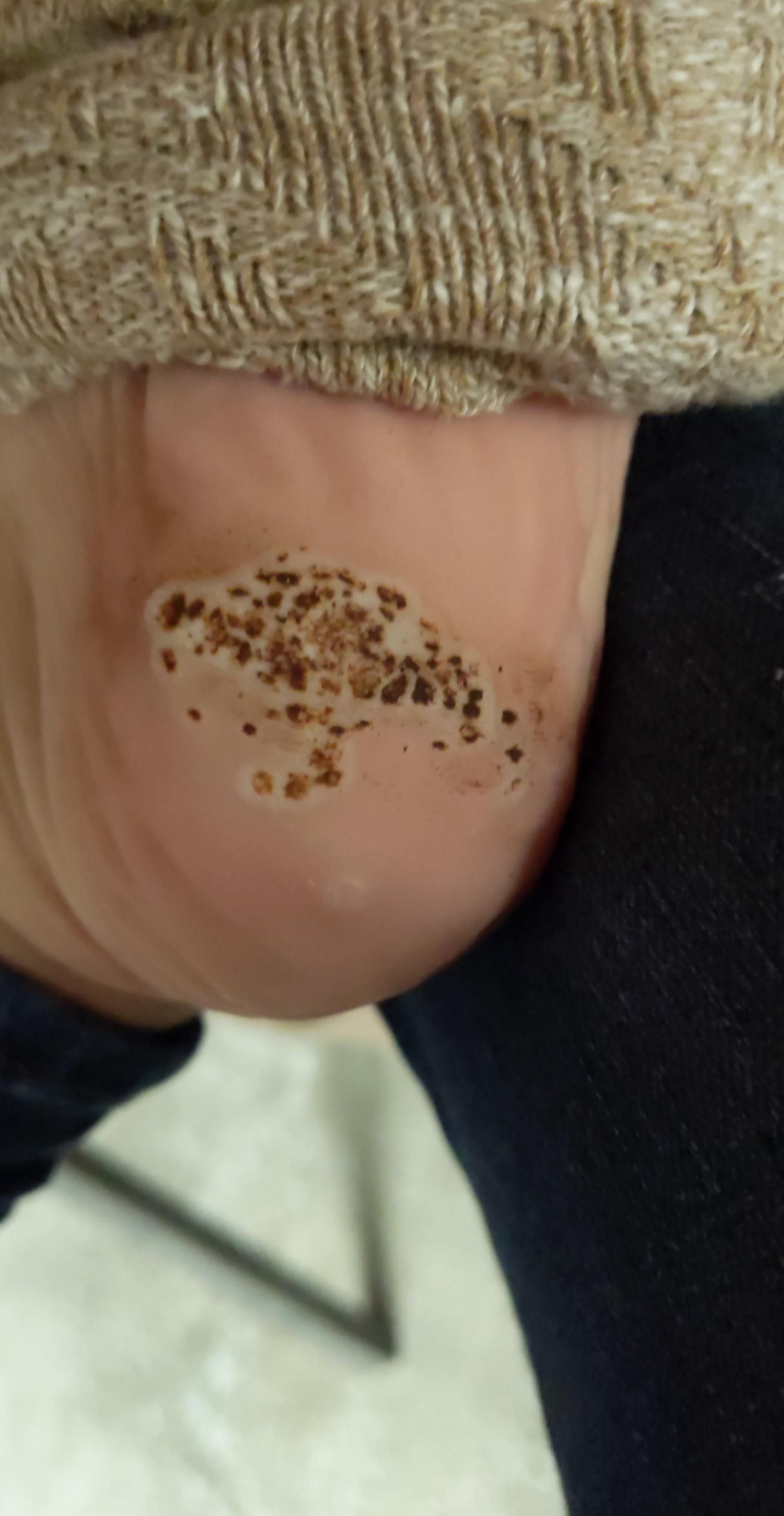 How To Remove Warts With Banana Peel Banana Poster