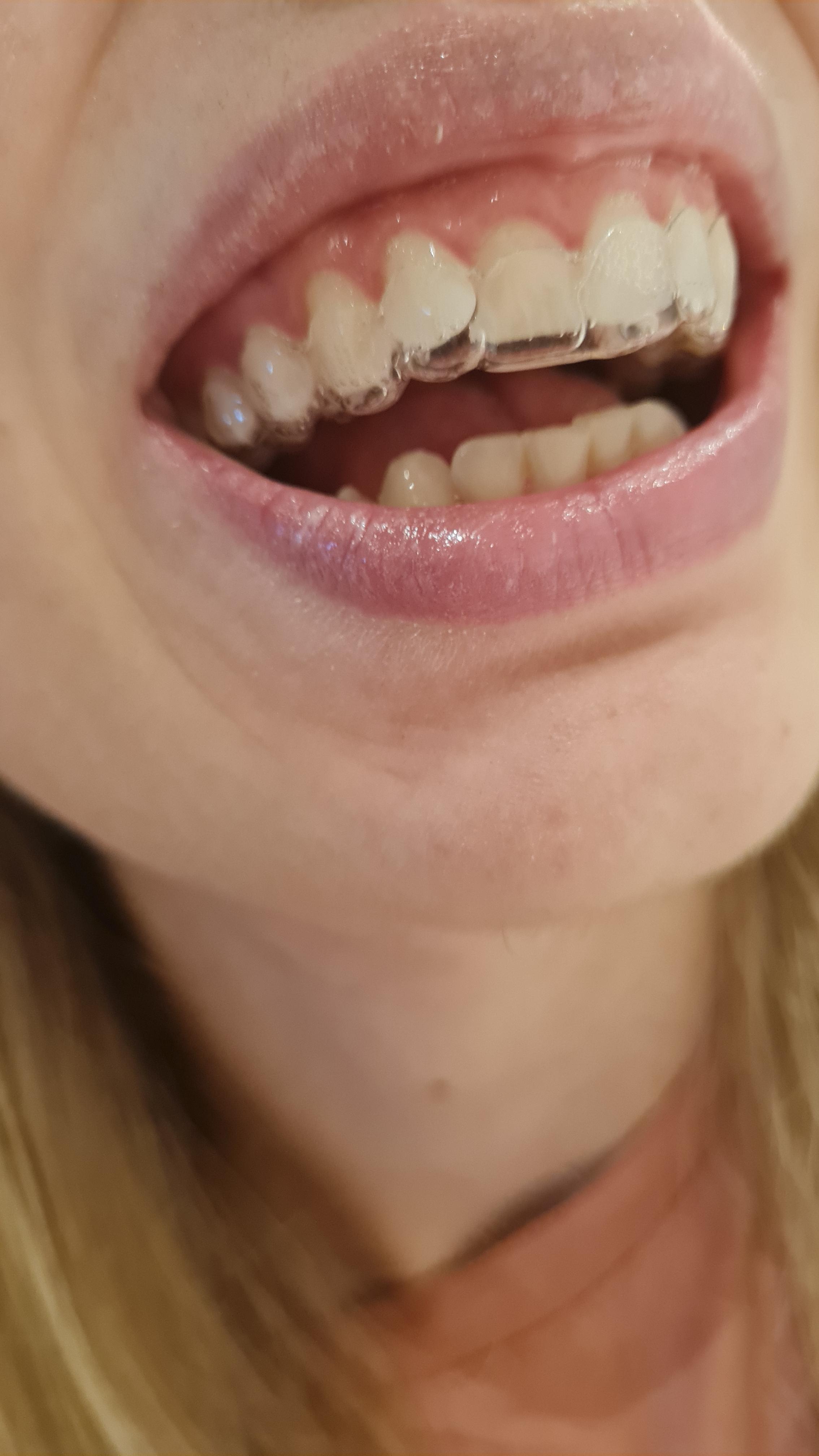 Trays don't fit at all ortho says it's normal r/Invisalign