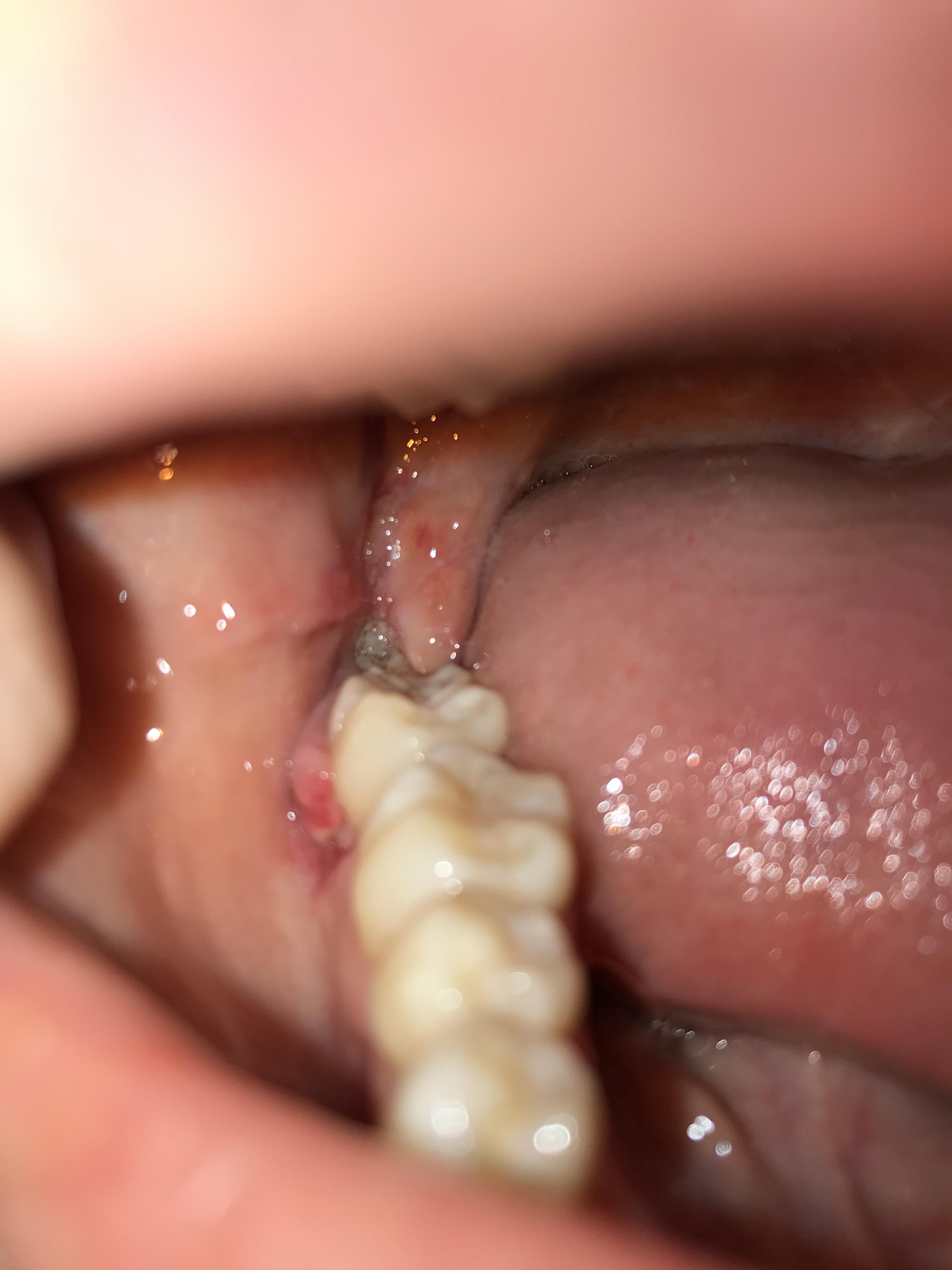 Stitches fell out on day 7, does this extraction site look normal? I’m