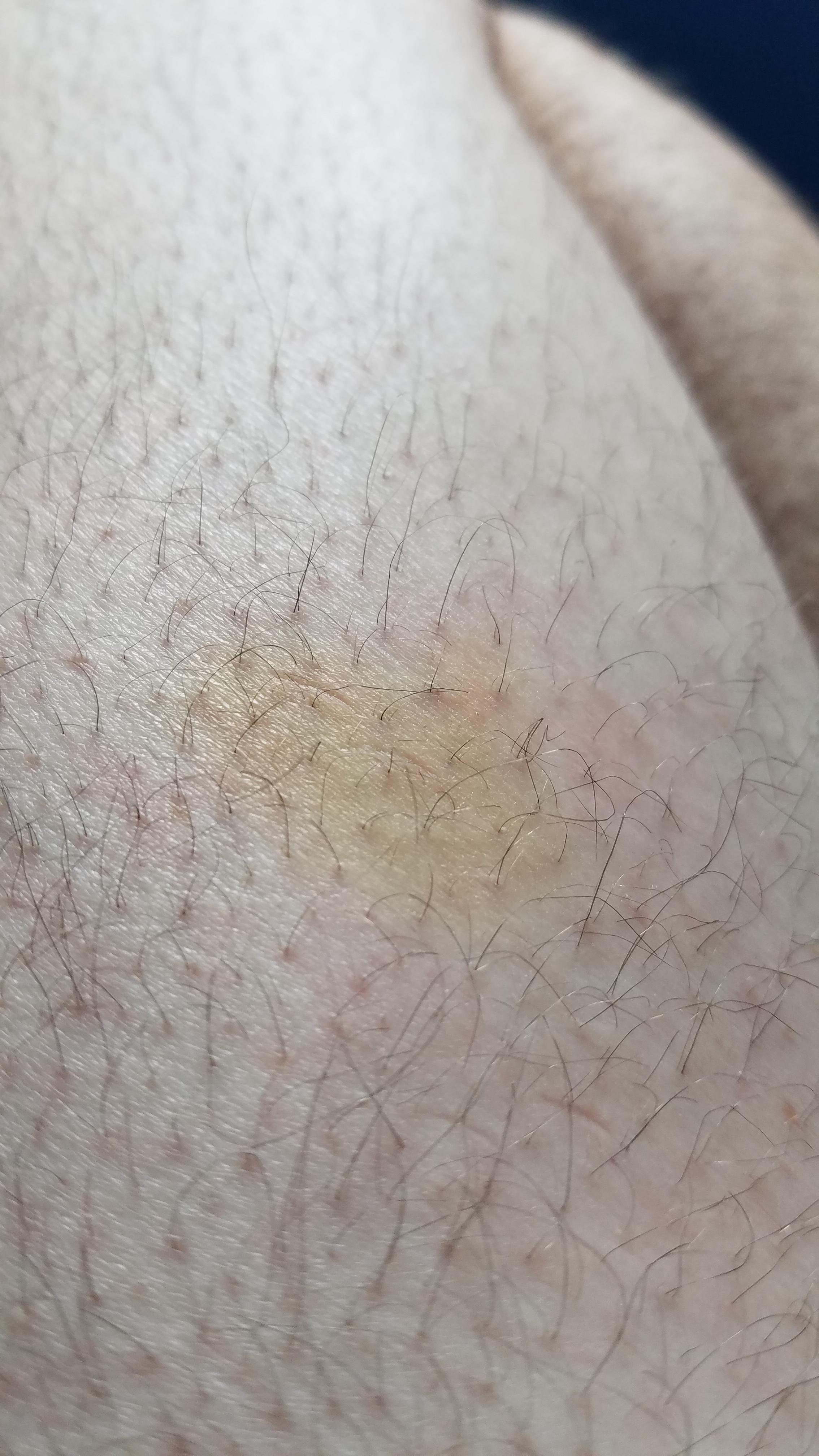 Did my shot last Tuesday and now there's a yellow bruise in the spot