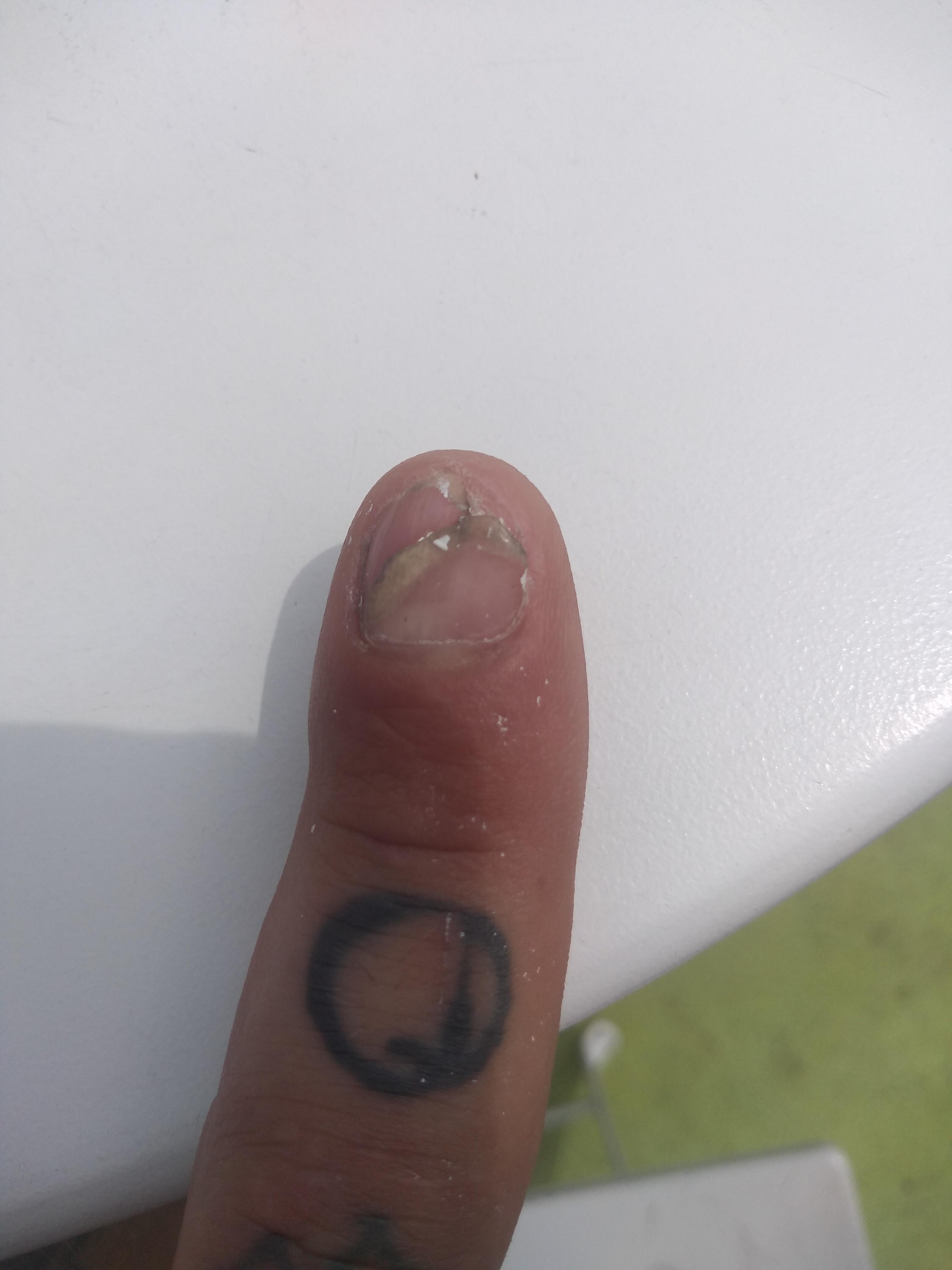 My fingernail growing back two nails. r/mildlyinteresting