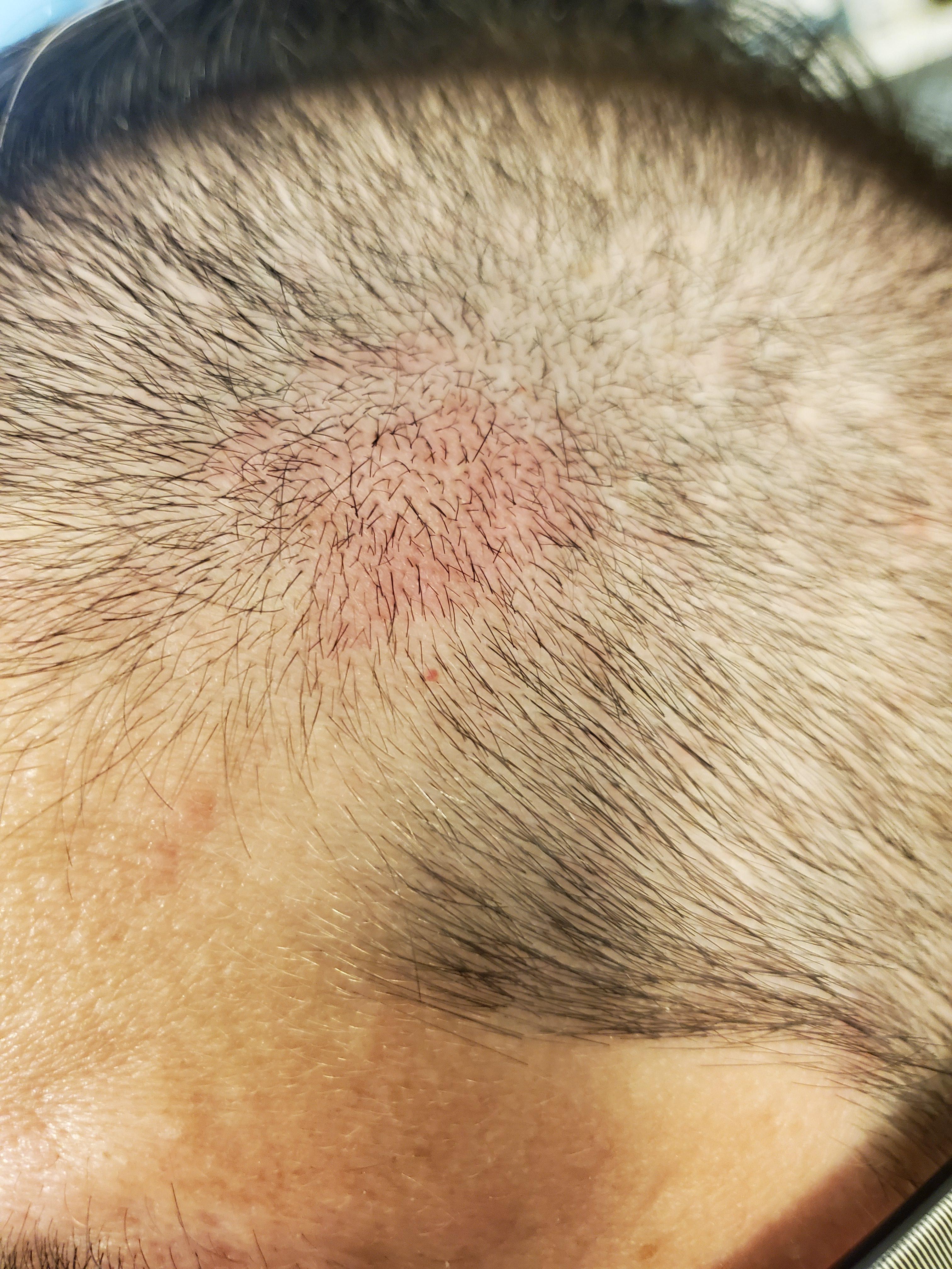 Regularly get purple itchy bumps on my scalp. They "spawn" in 4