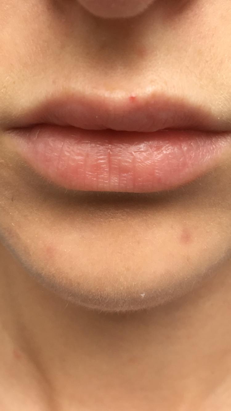 [skin concerns] How can I get rid of this broken blood vessel on top of