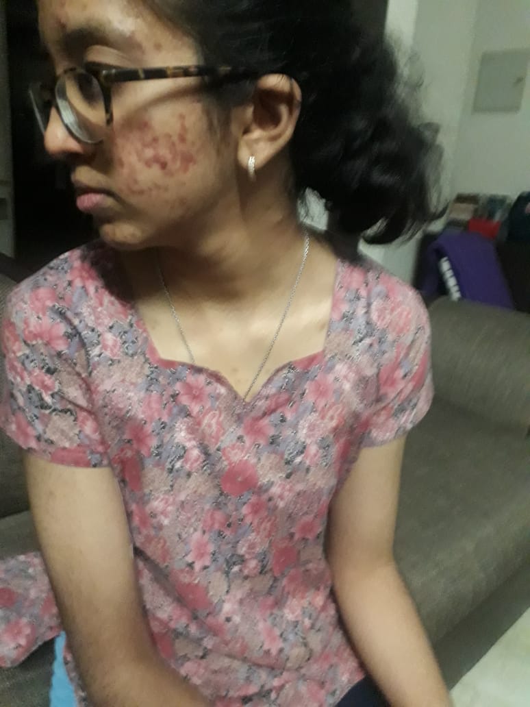 Peeling is not what I thought tretinoin