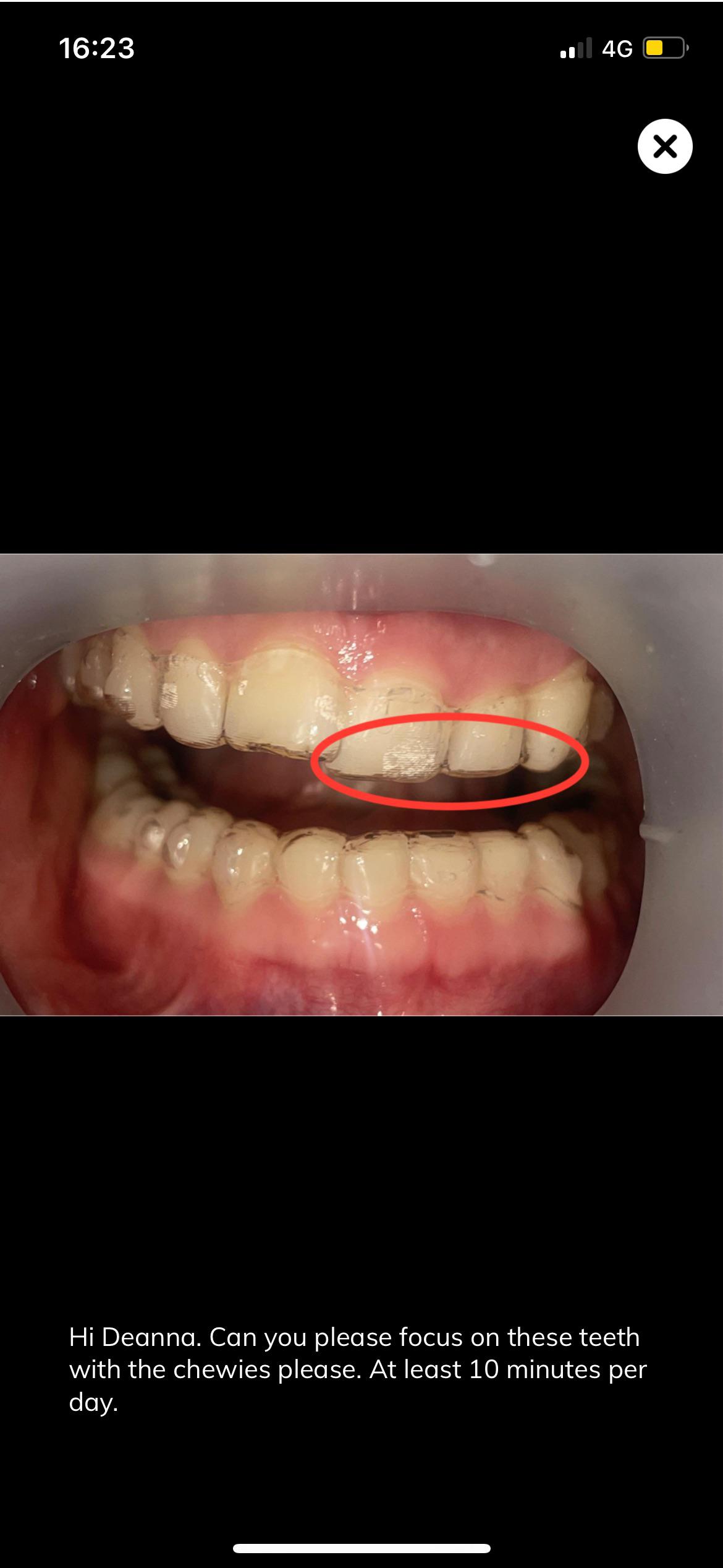 Teeth not tracking (more in comments) r/Invisalign