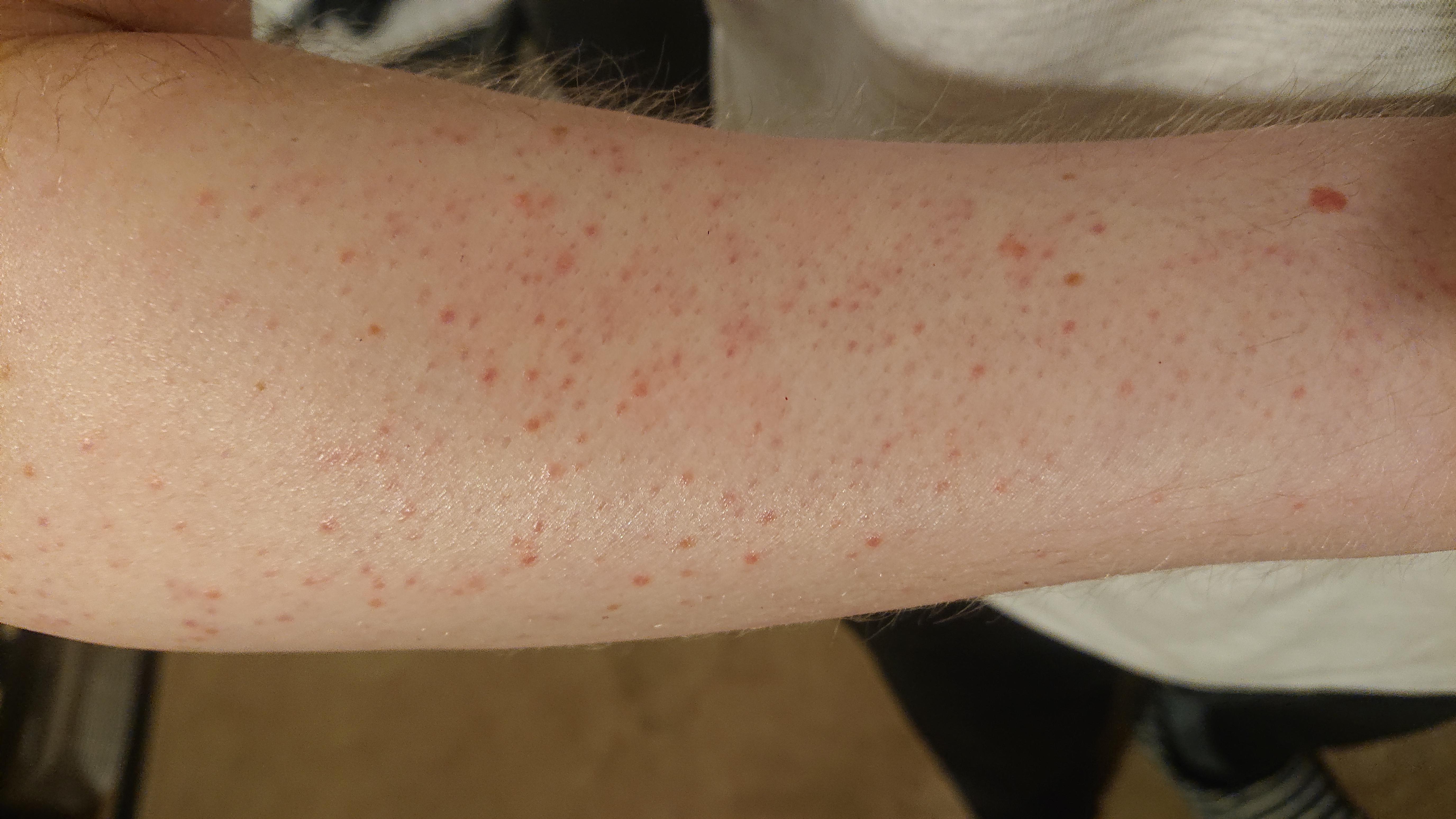 Currently using Cerave Moisturizing Cream after every shower and their rough and bumpy SA cream