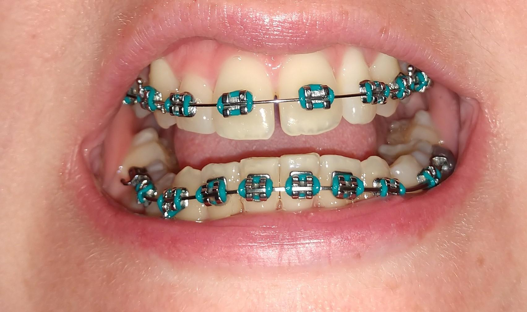 New wire... Ouch r/braces