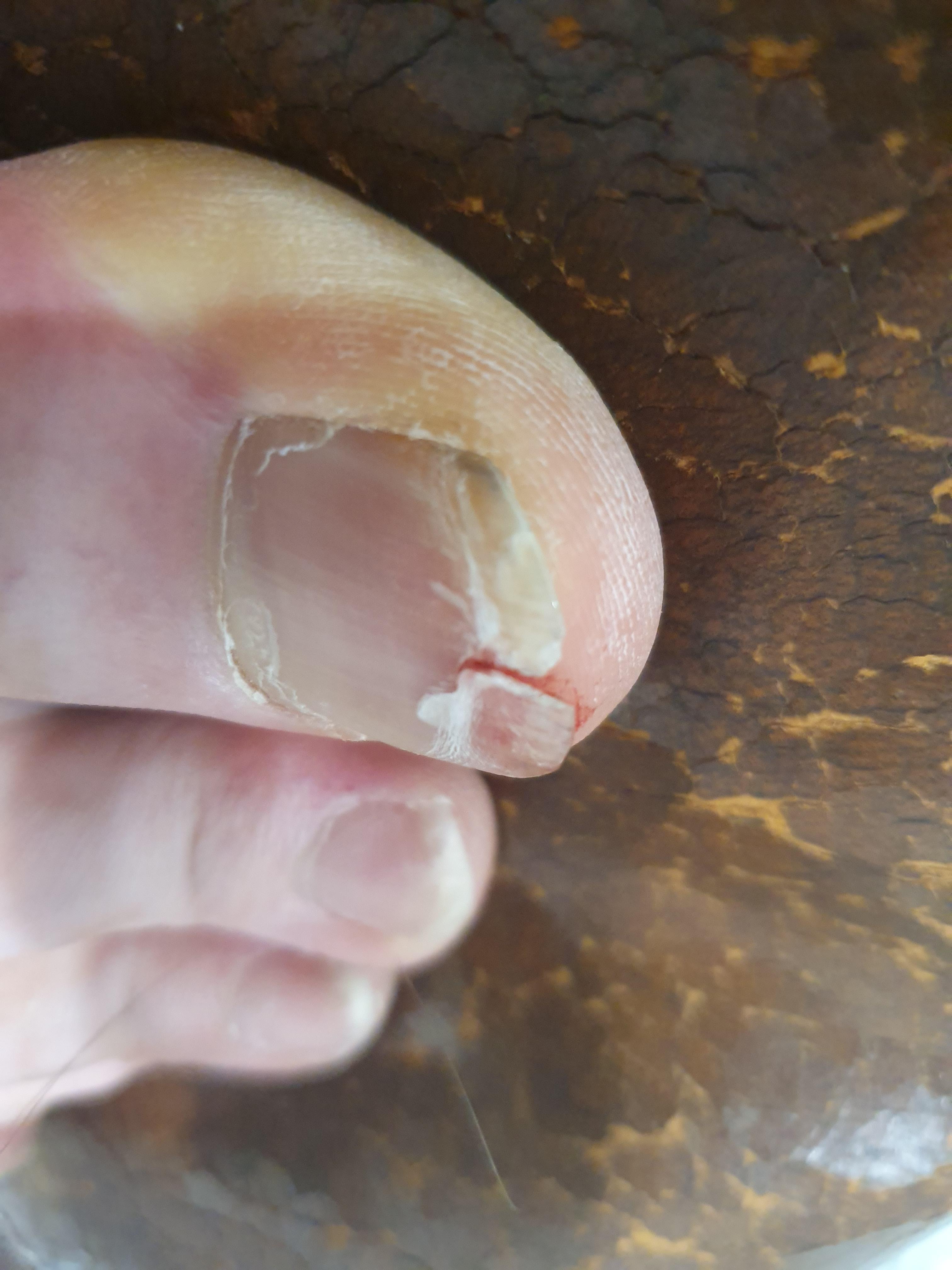 Today's VR injury, peeling back my toenail r/virtualreality