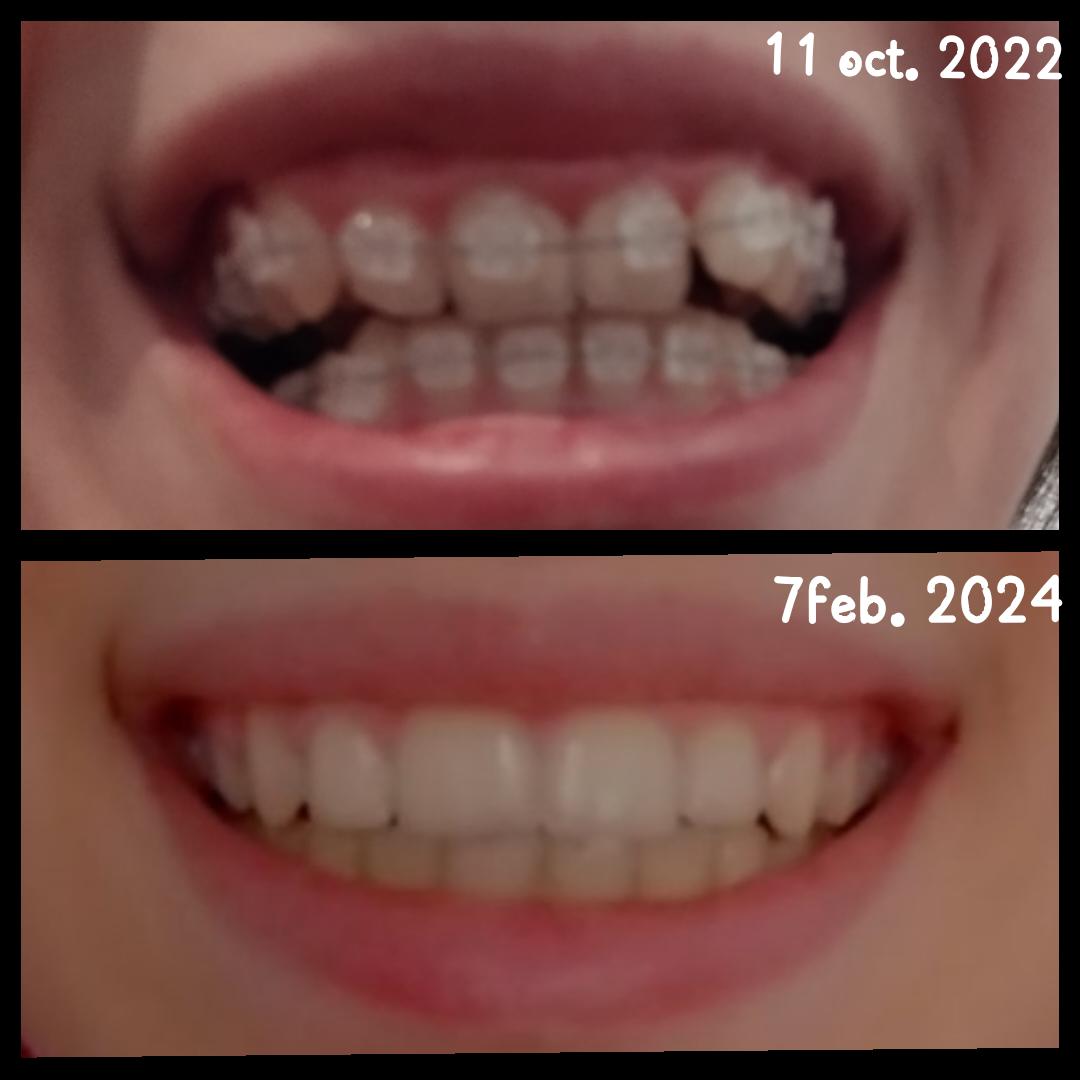 Retainers after braces r/braces
