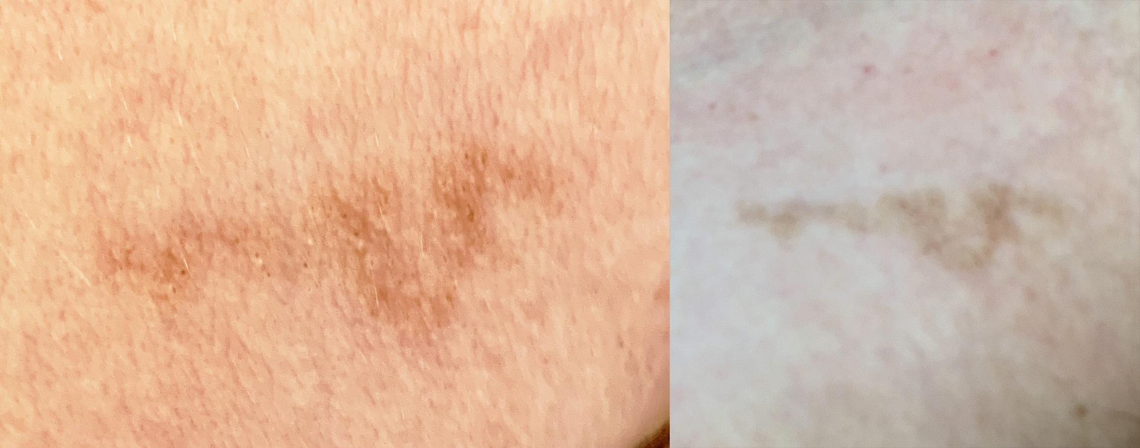 Skin cancer? Noticed it several months ago near left armpit on the