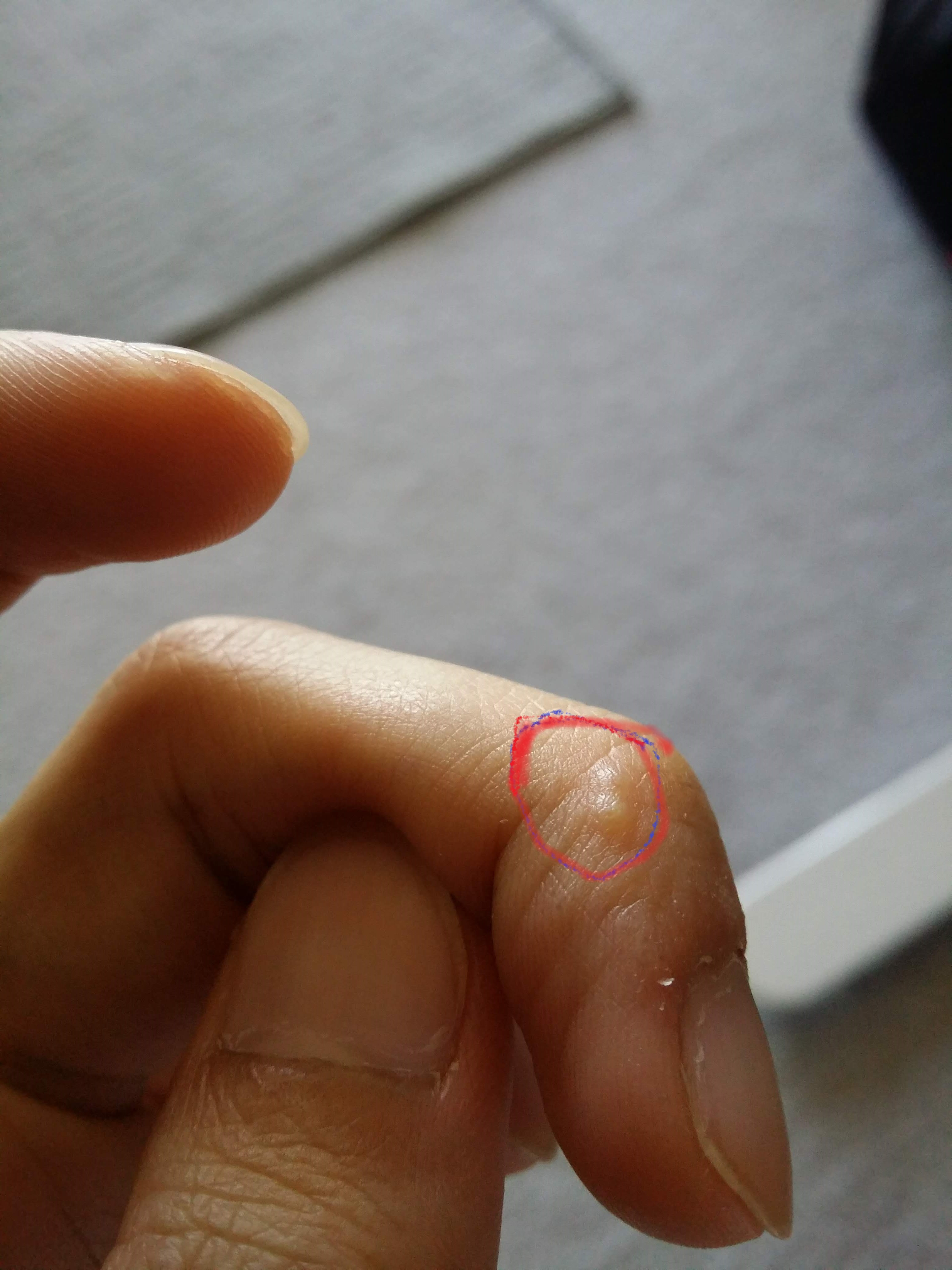 Blisters around my finger tips, any advice? r/Dermatology