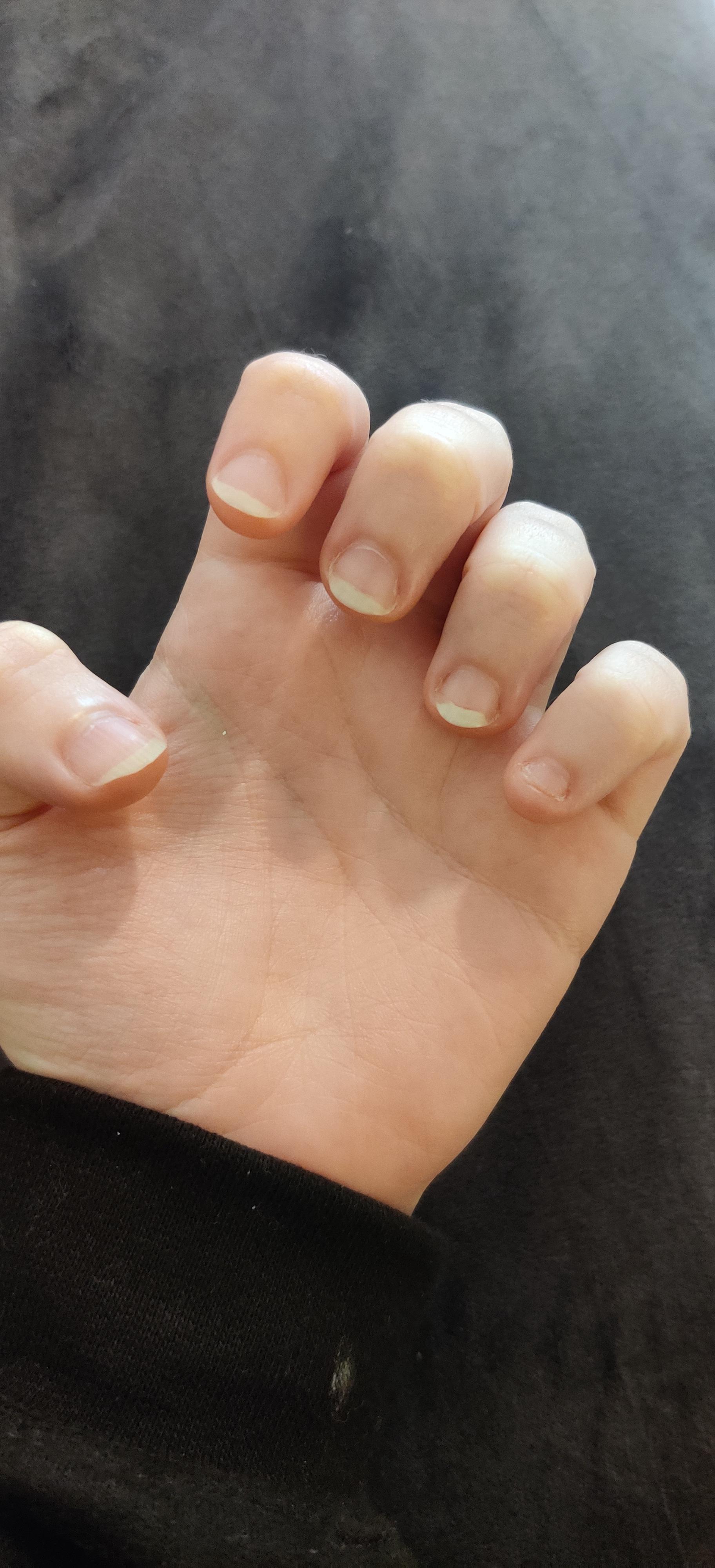 I've been biting my nails since before I can remember. Now at 23 I'm