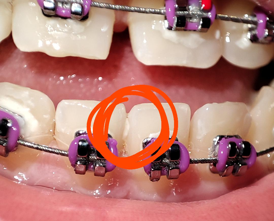 Brace Newbie here, I just got my braces and I noticed cement stuck in