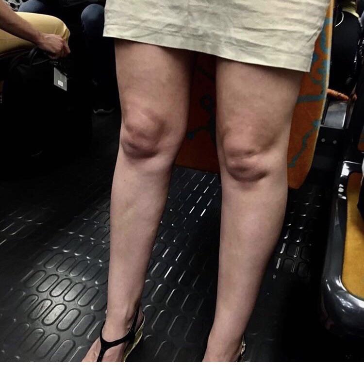 These knees look like two babies on a sonogram funny