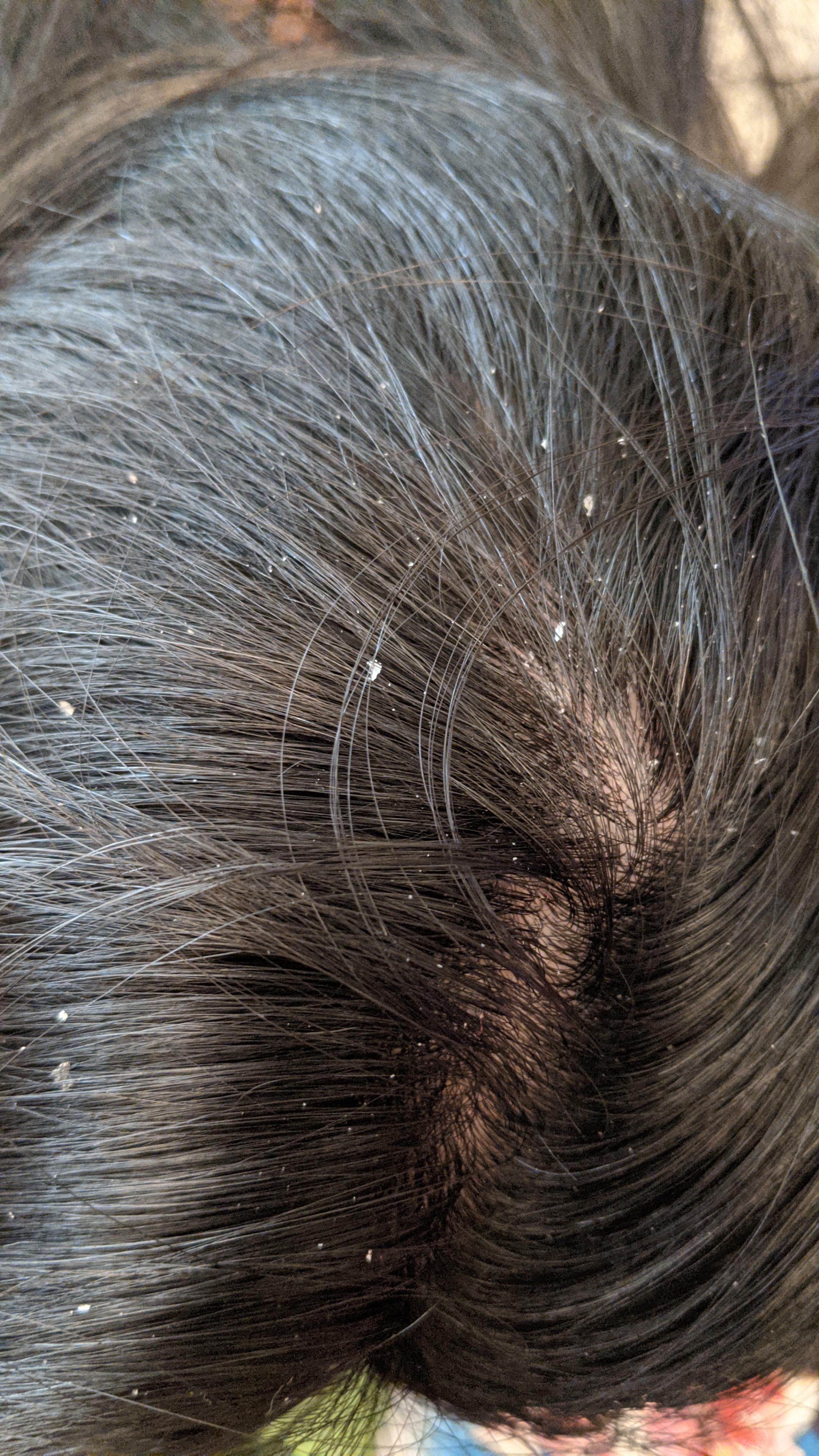 is head and shoulders bad for your hair reddit Tawna Spring