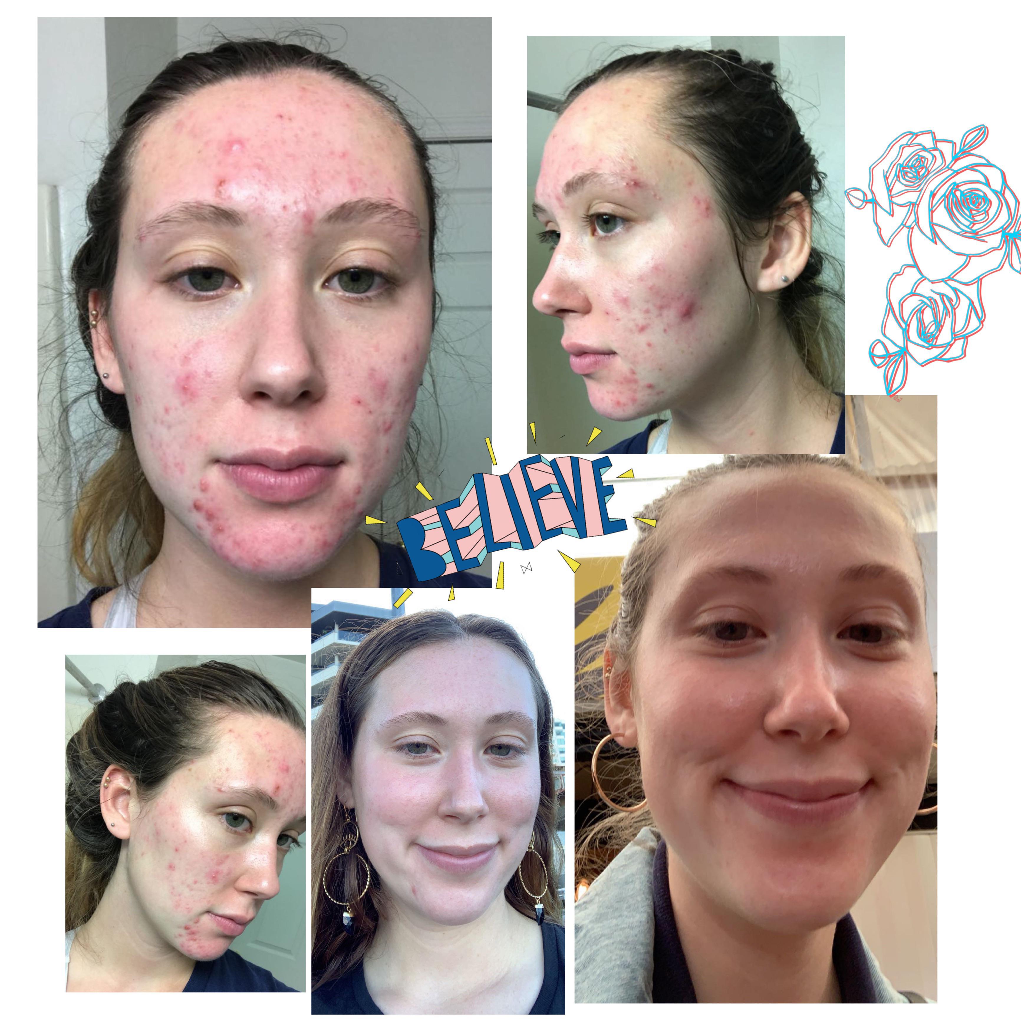Spiro DID ITS THING! r/acne