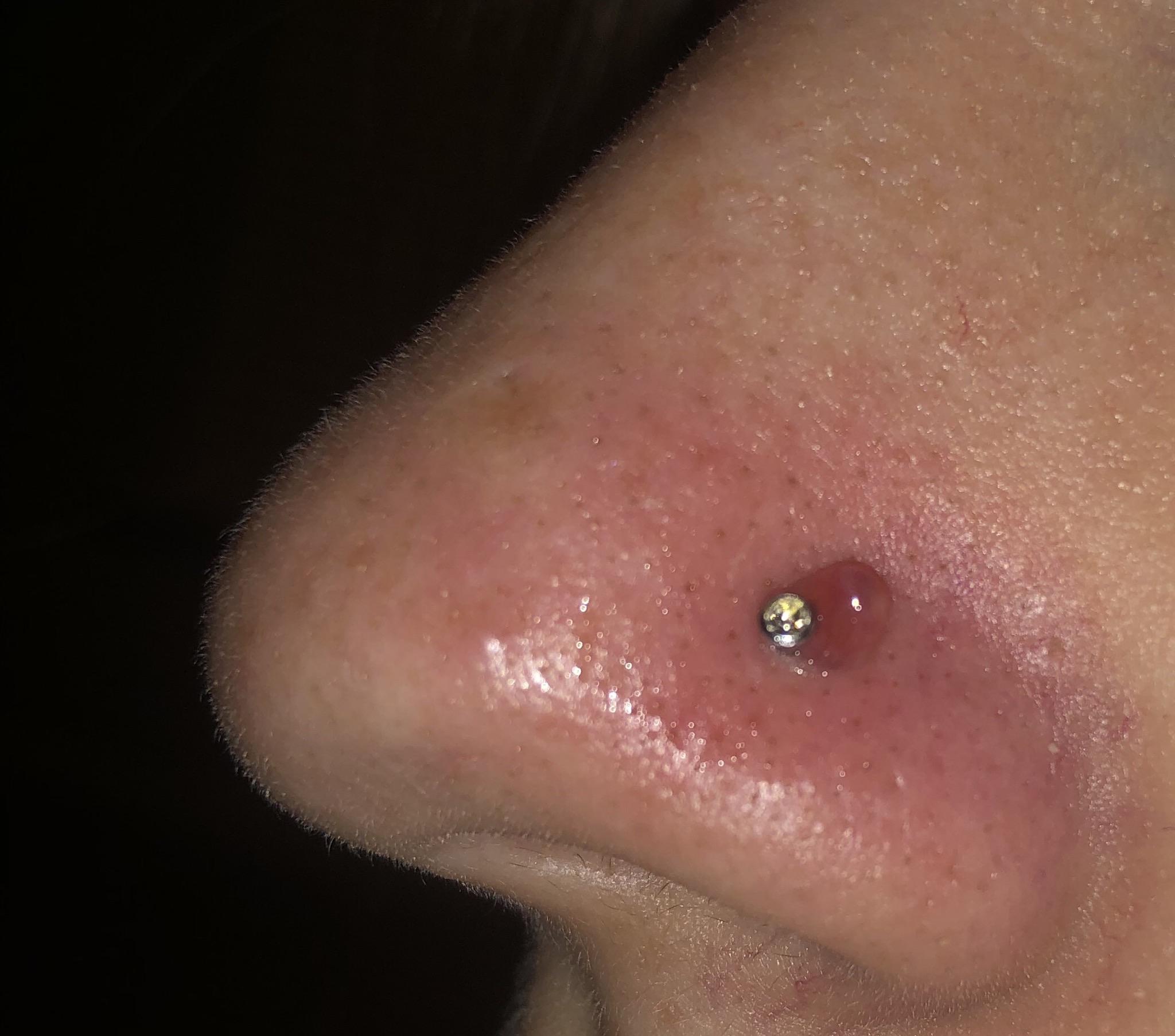 Nose piercing bump that won’t go away, not sure if it’s a keyloid or