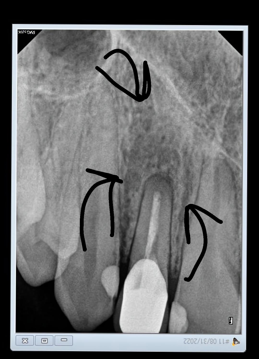 This tooth is a retreated root canal that started aching after a year