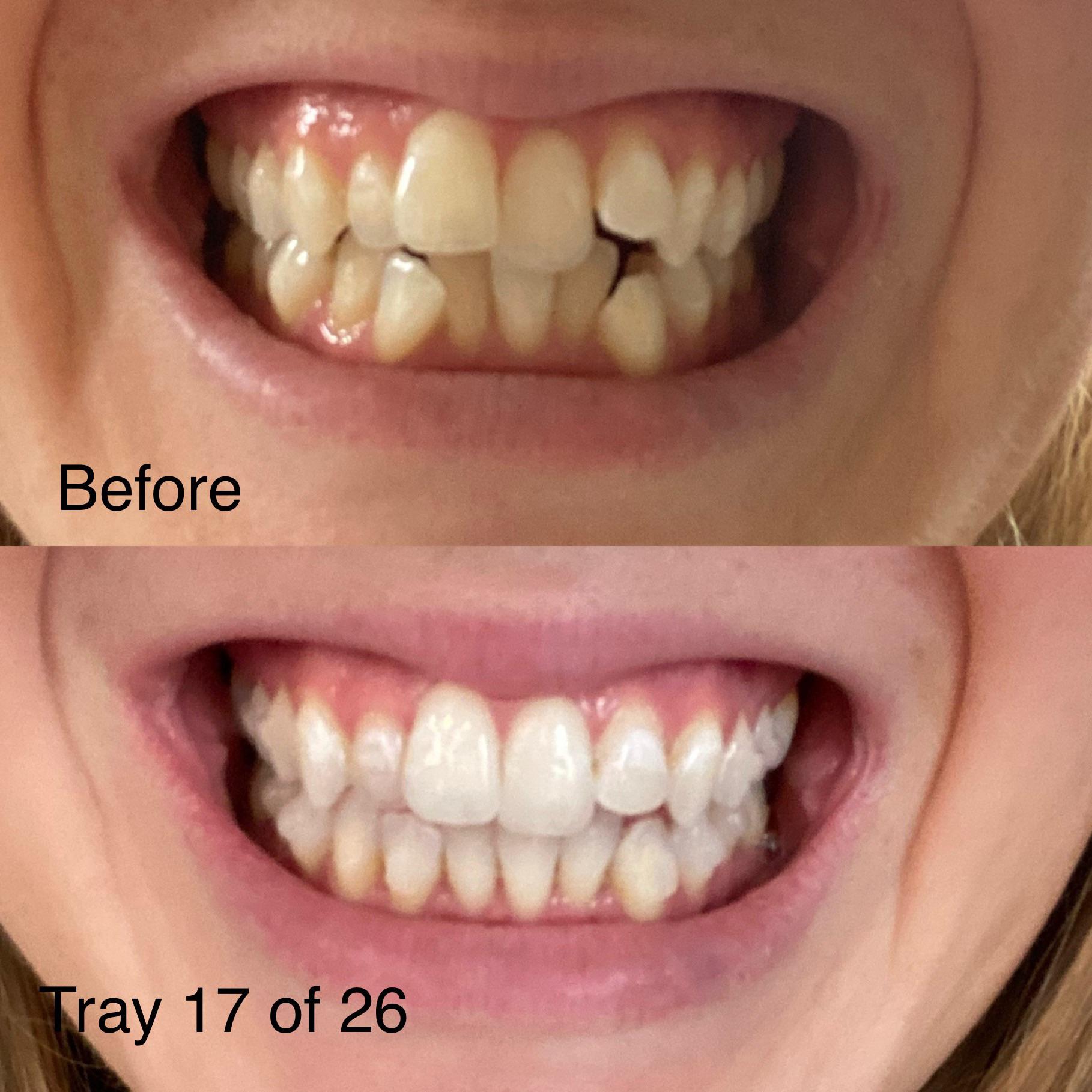 Before and after (so far— on tray 17 of 26) Invisalign