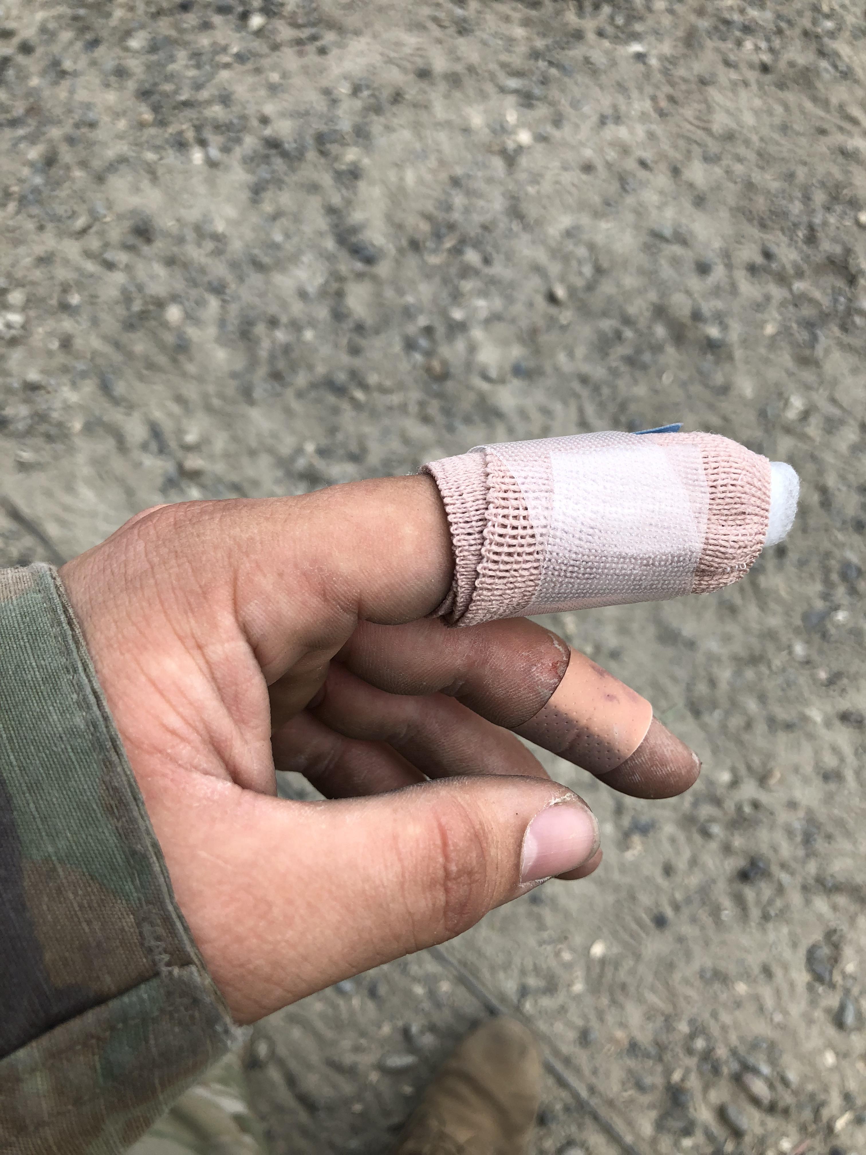 Hand slipped while opening a cot. Almost lost a finger. Thanks army