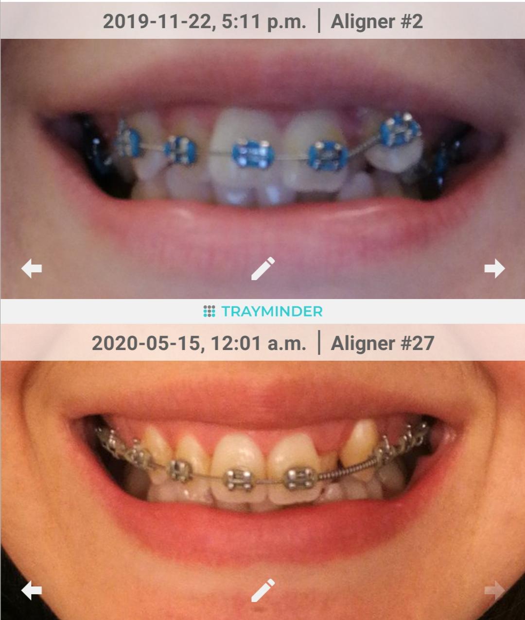 6 Month Update 25 done! 27X r/braces