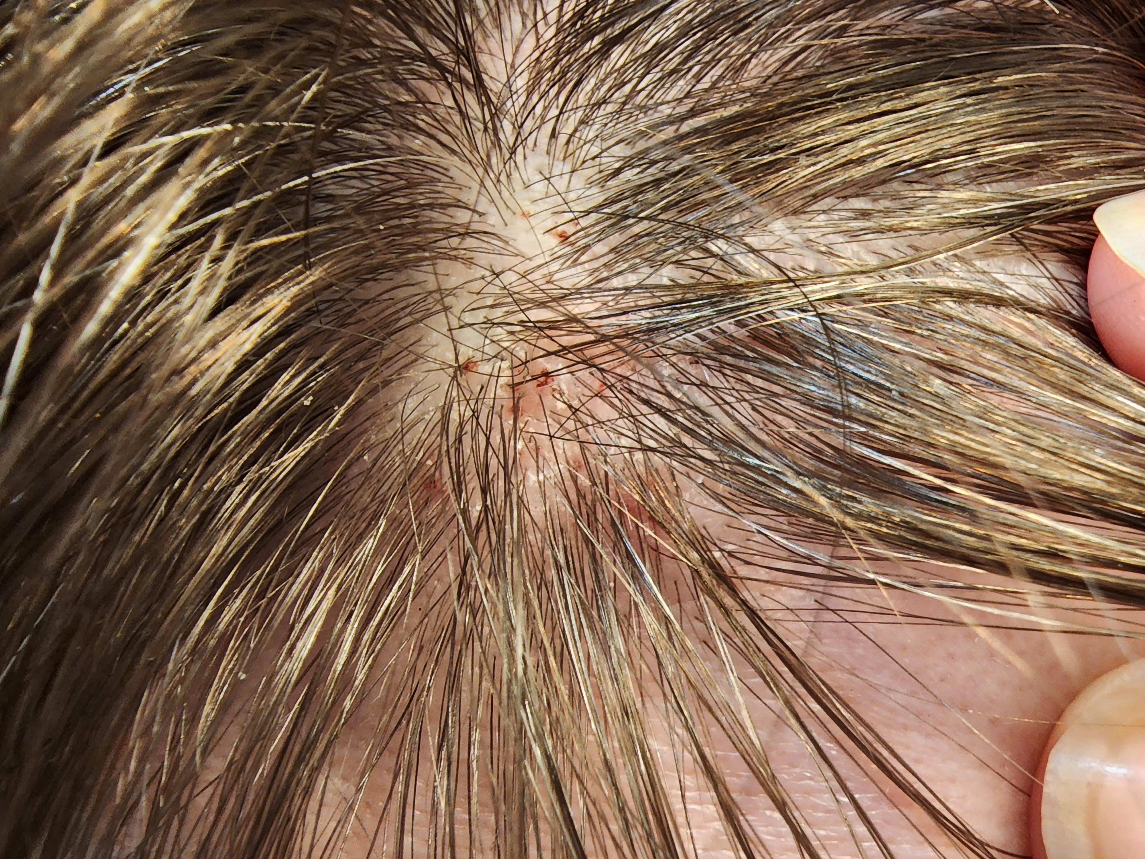 dry scalp. any product suggestions? r/femalehairadvice