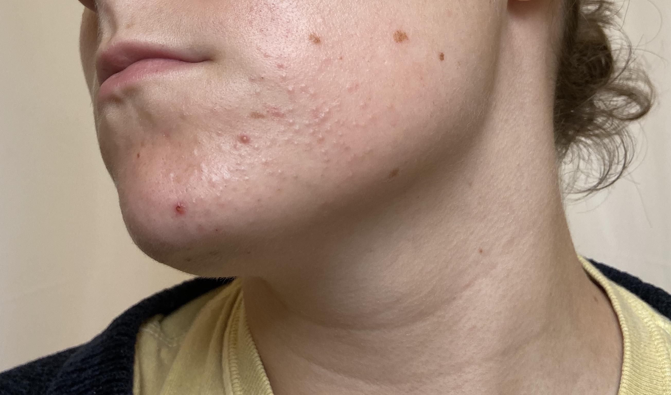 I used to have clear skin while on CHC pill, now on Mirena and I have