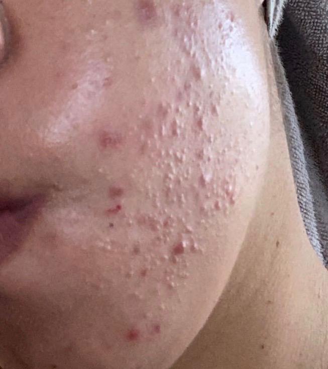 Skin Concerns These Tiny Bumps Are All Over My Cheeks And Jawline And